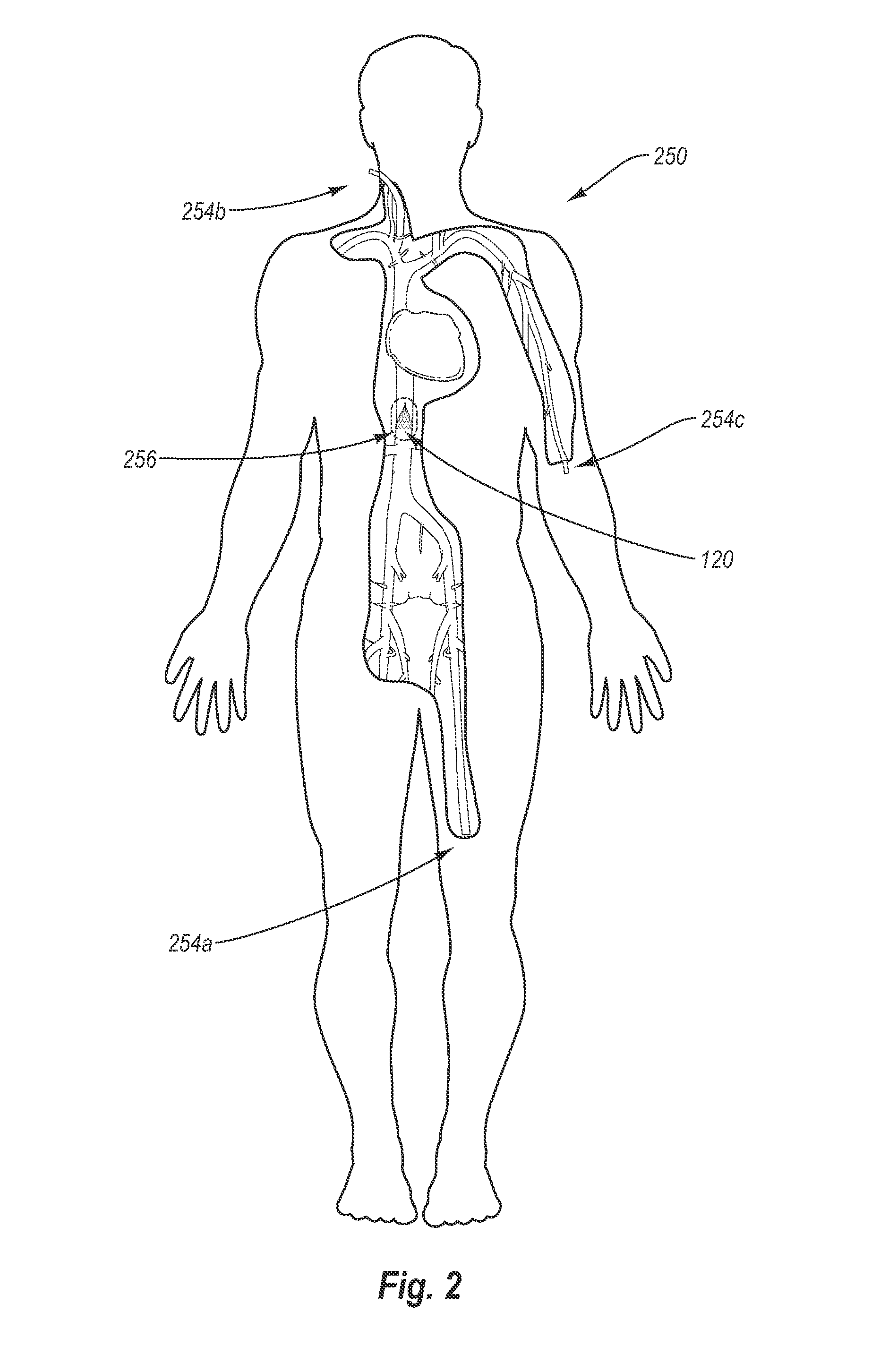 Body lumen filter retrieval system and methods for filtering a body lumen