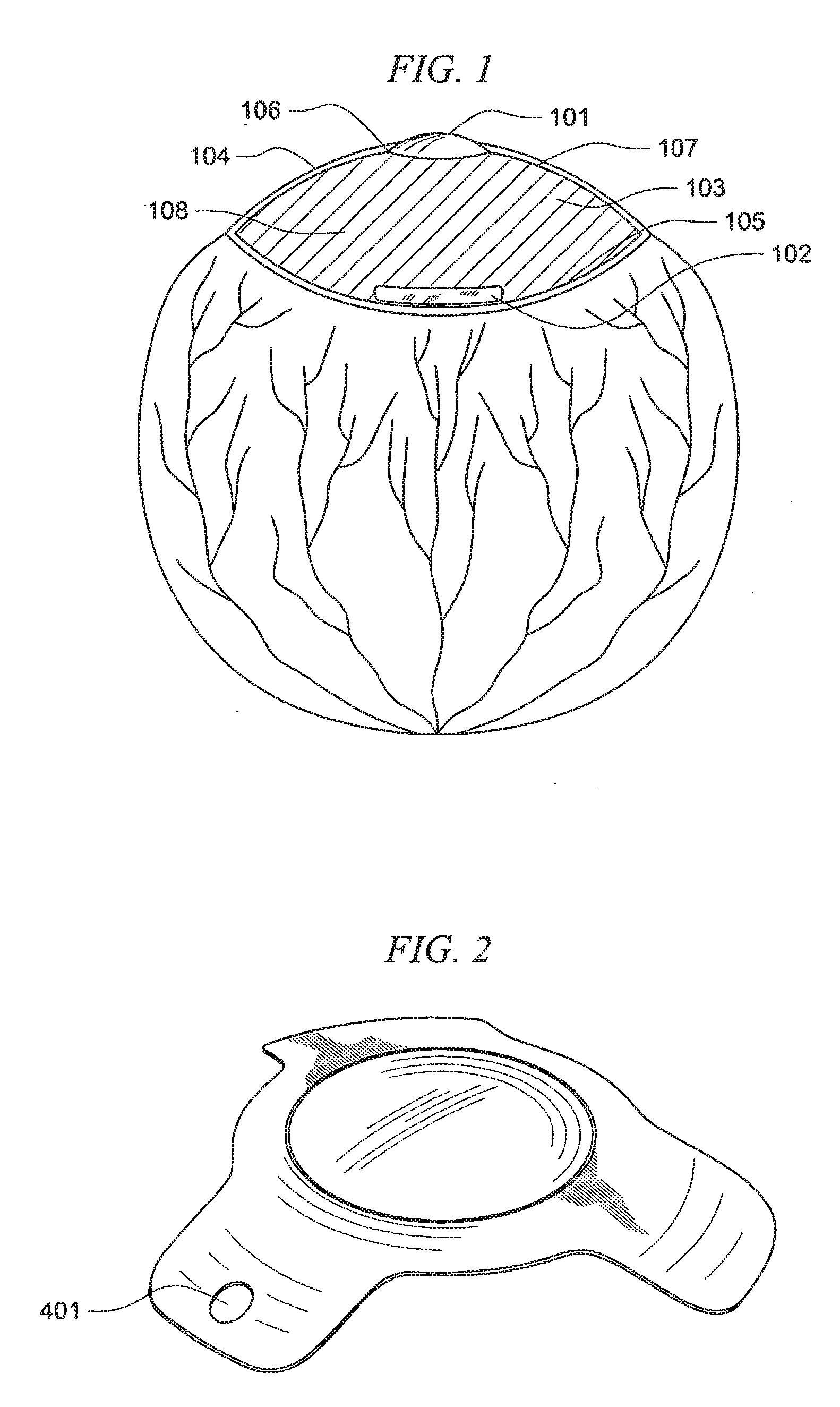 Multilens Intraocular System with Injectable Accommodation Material