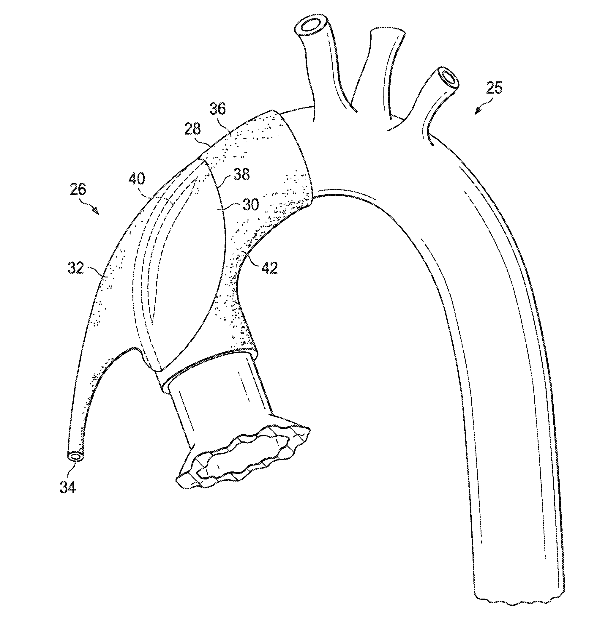 Fully implantable direct cardiac and aortic compression device