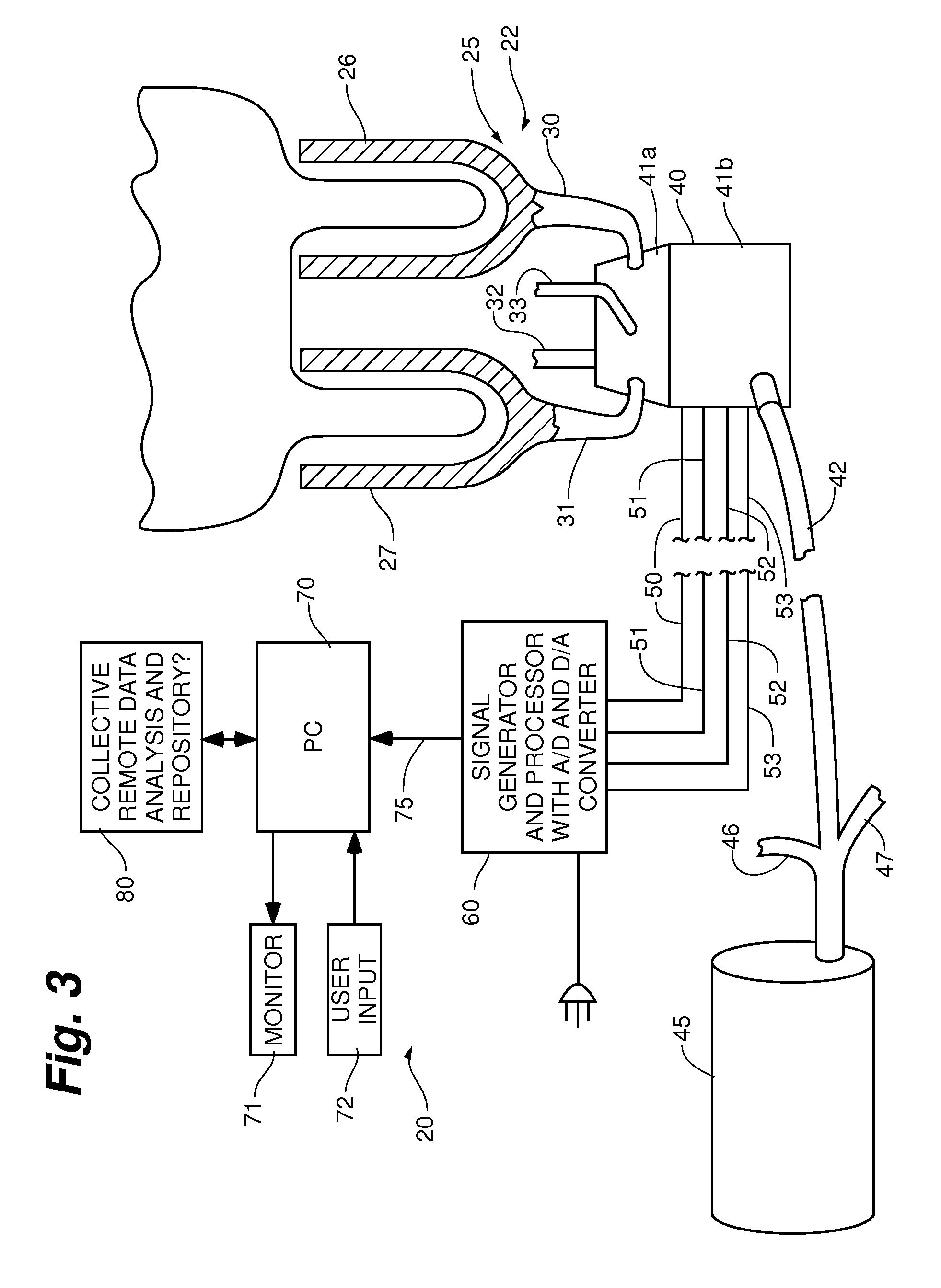 System and method of sub clinical detecting mastitis