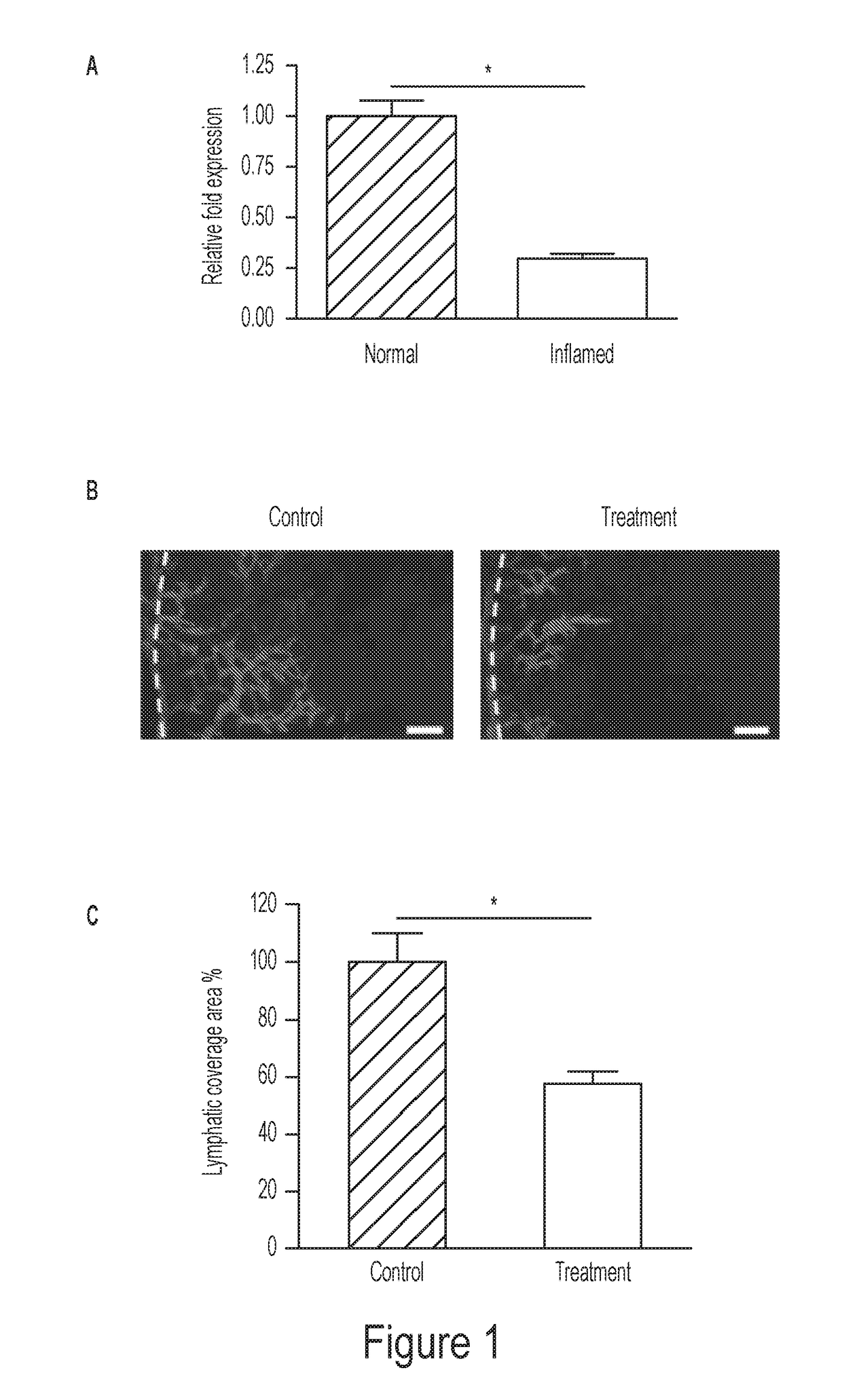 Modulation of microrna 184 to treat pathological lymphangiogenesis