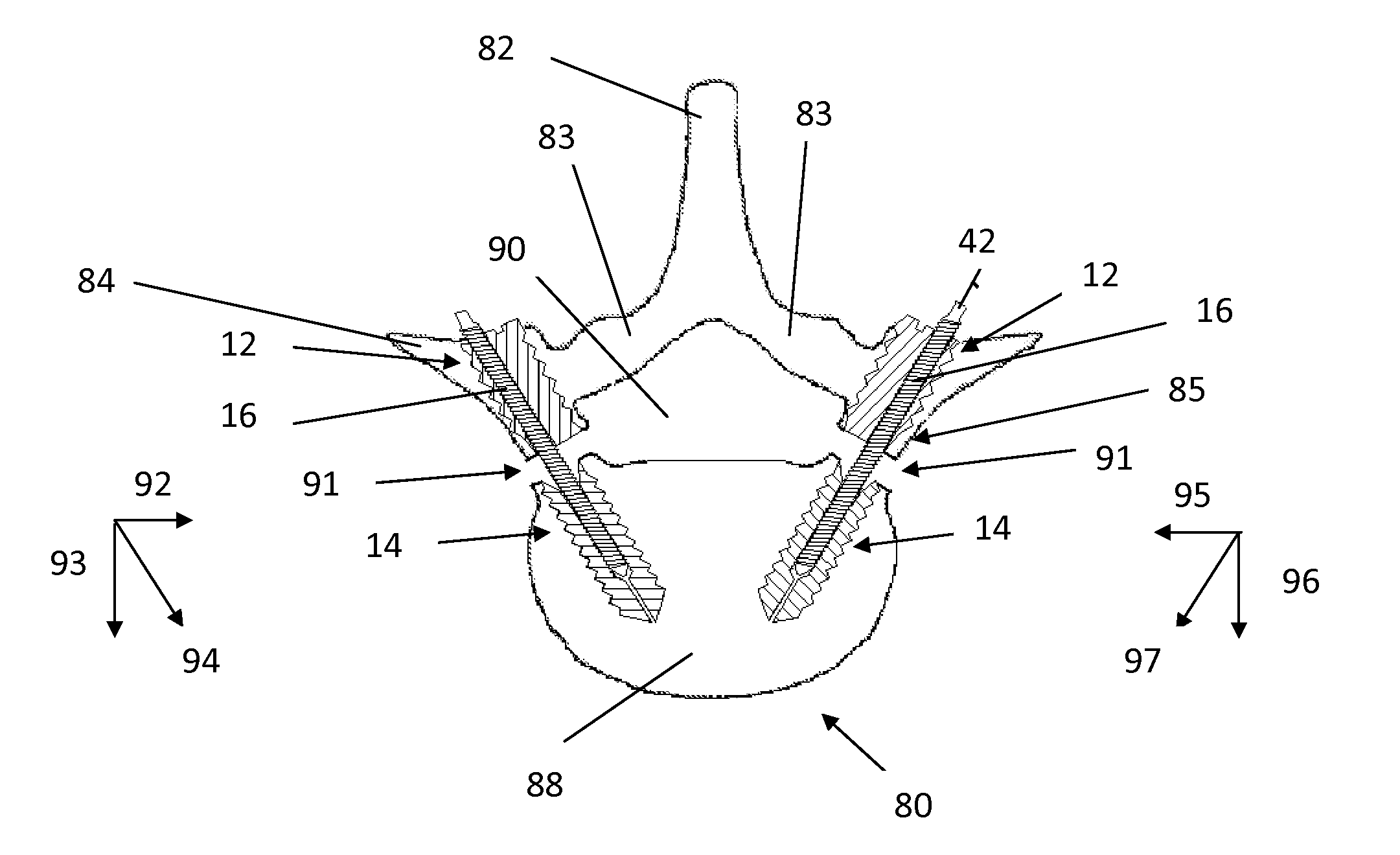 Surgical Implants For Percutaneous Lengthening Of Spinal Pedicles To Correct Spinal Stenosis