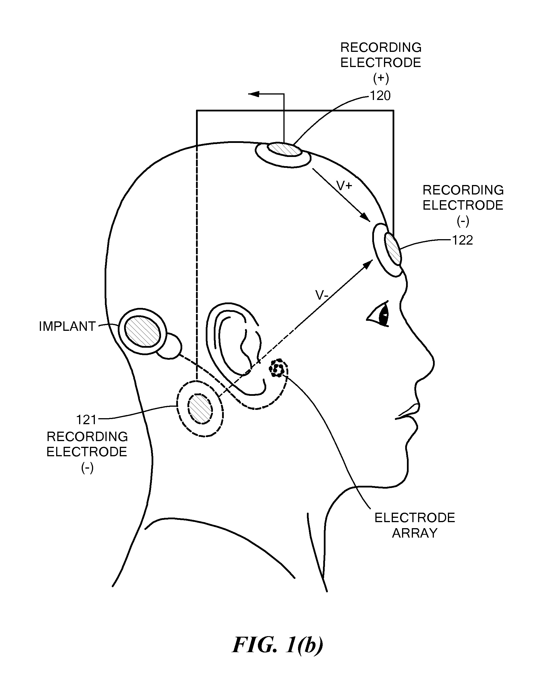 Electrically Evoked Brainstem Response Measurements via Implant Prosthesis