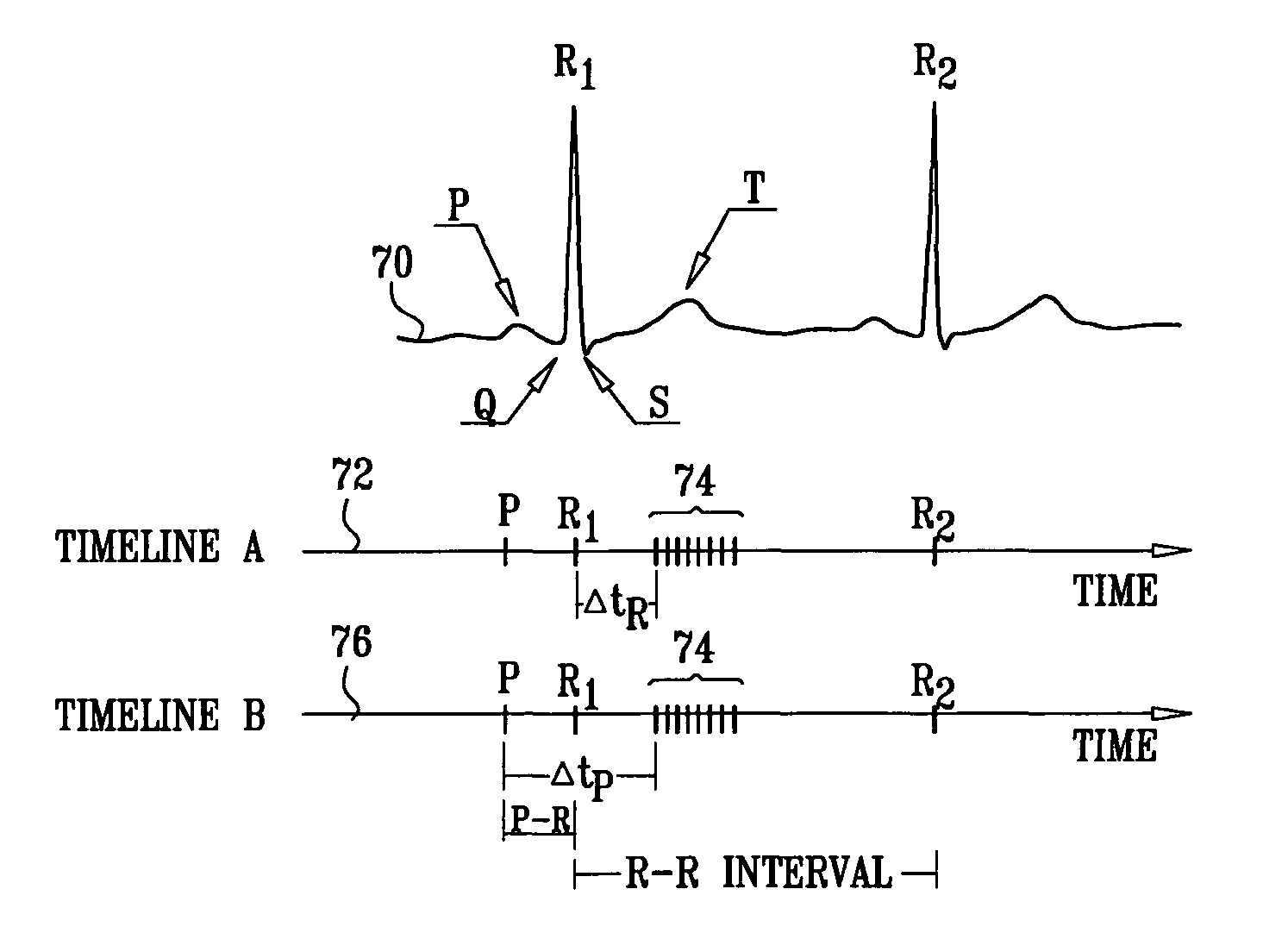 Techniques for prevention of atrial fibrillation