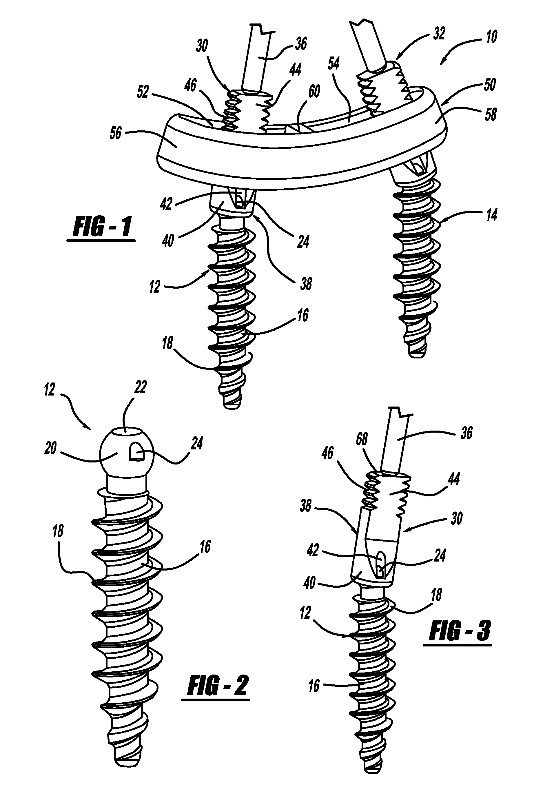 Pedicle Screw and Rod System