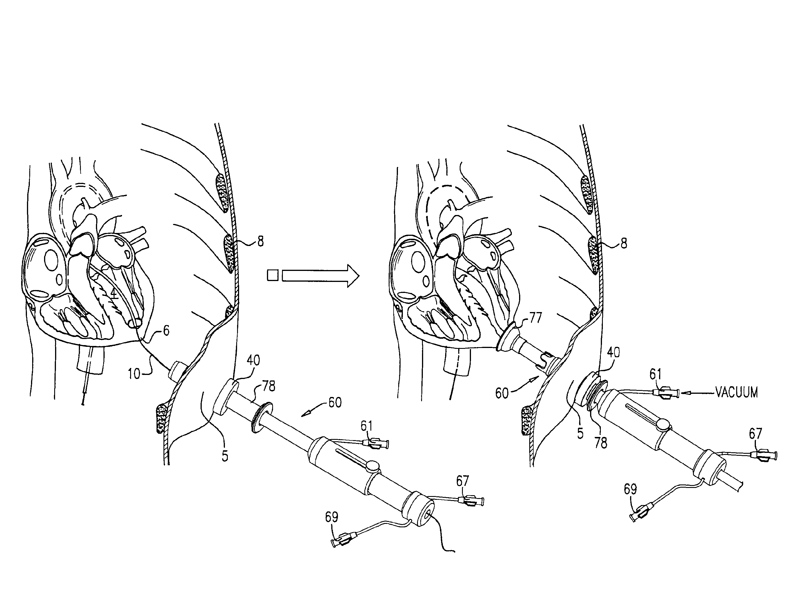 Minimally invasive surgical techniques