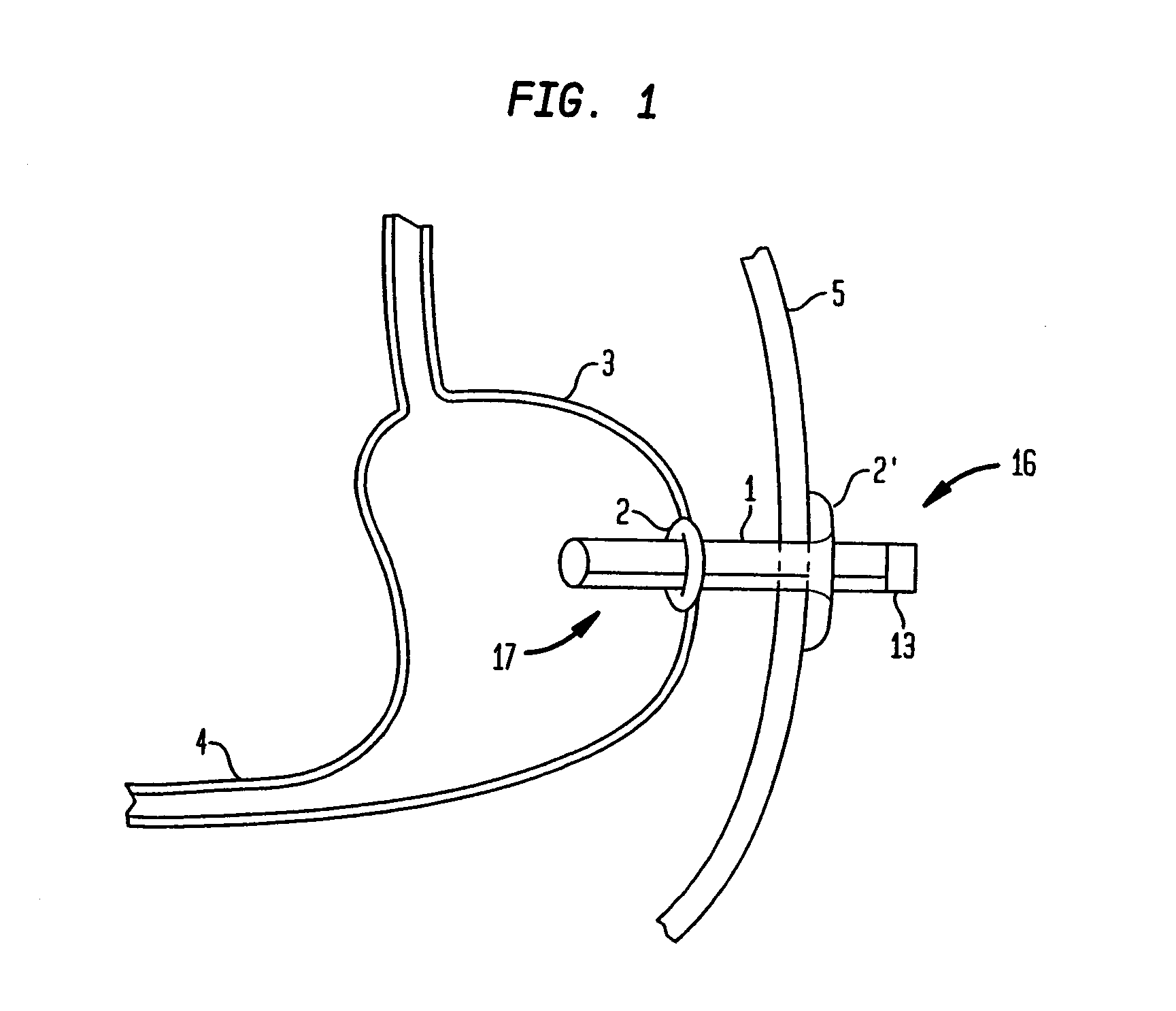 Method for treating obesity by extracting food