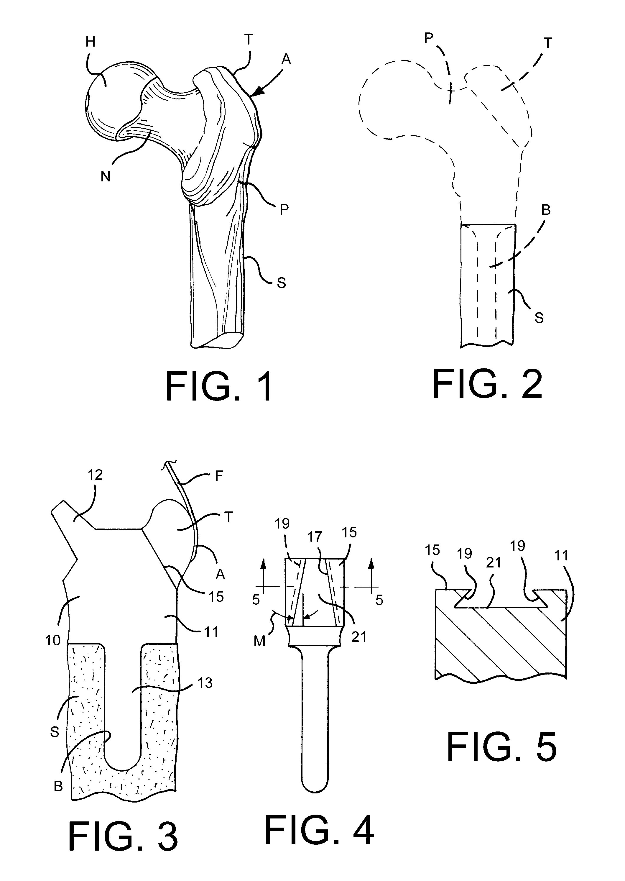 Soft tissue attachment system and method