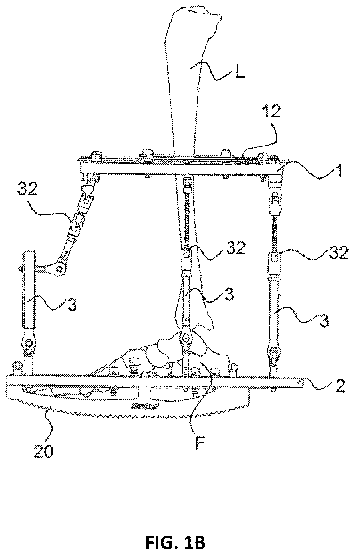 External fixator system