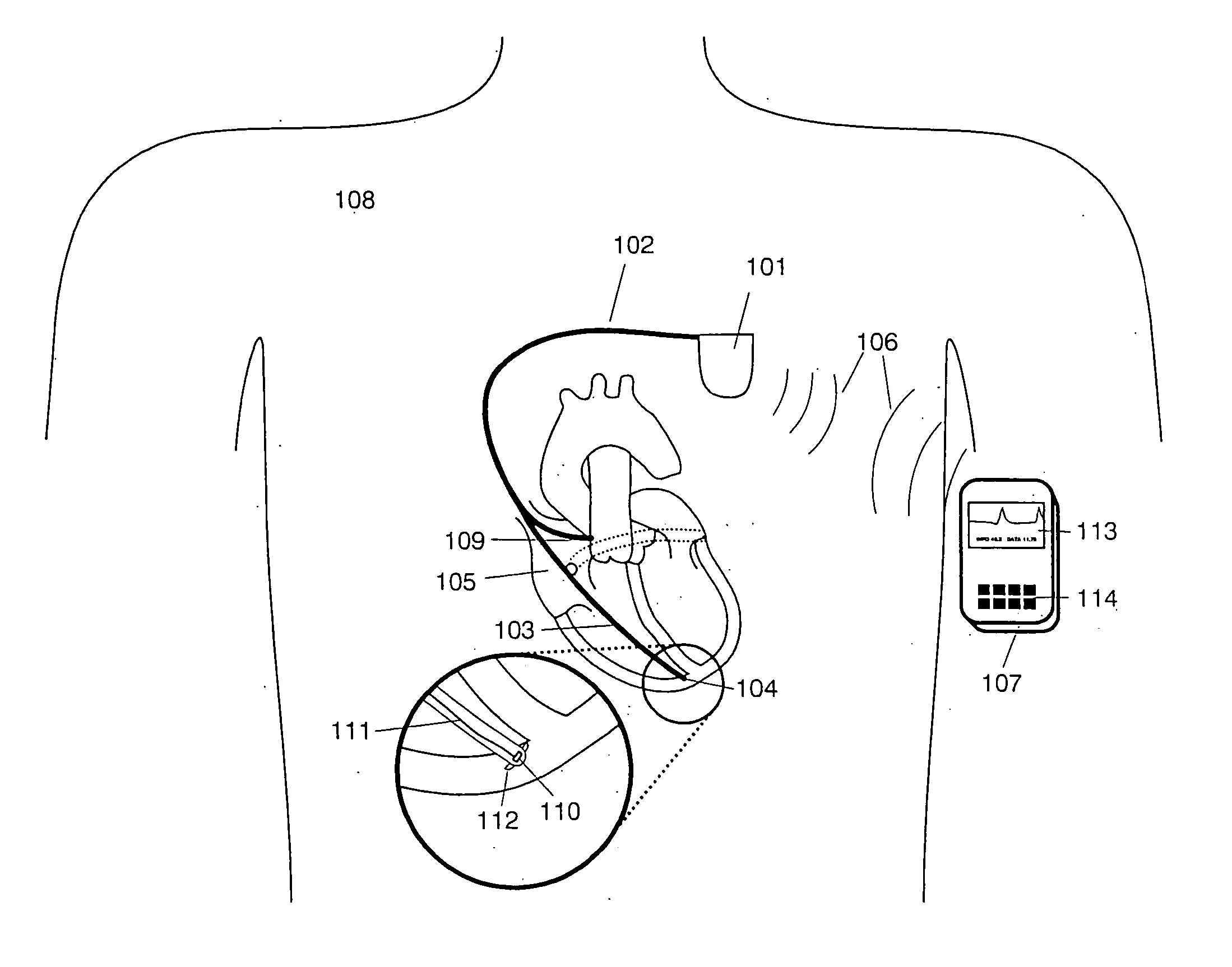 Detection of apex motion for monitoring cardiac dysfunction