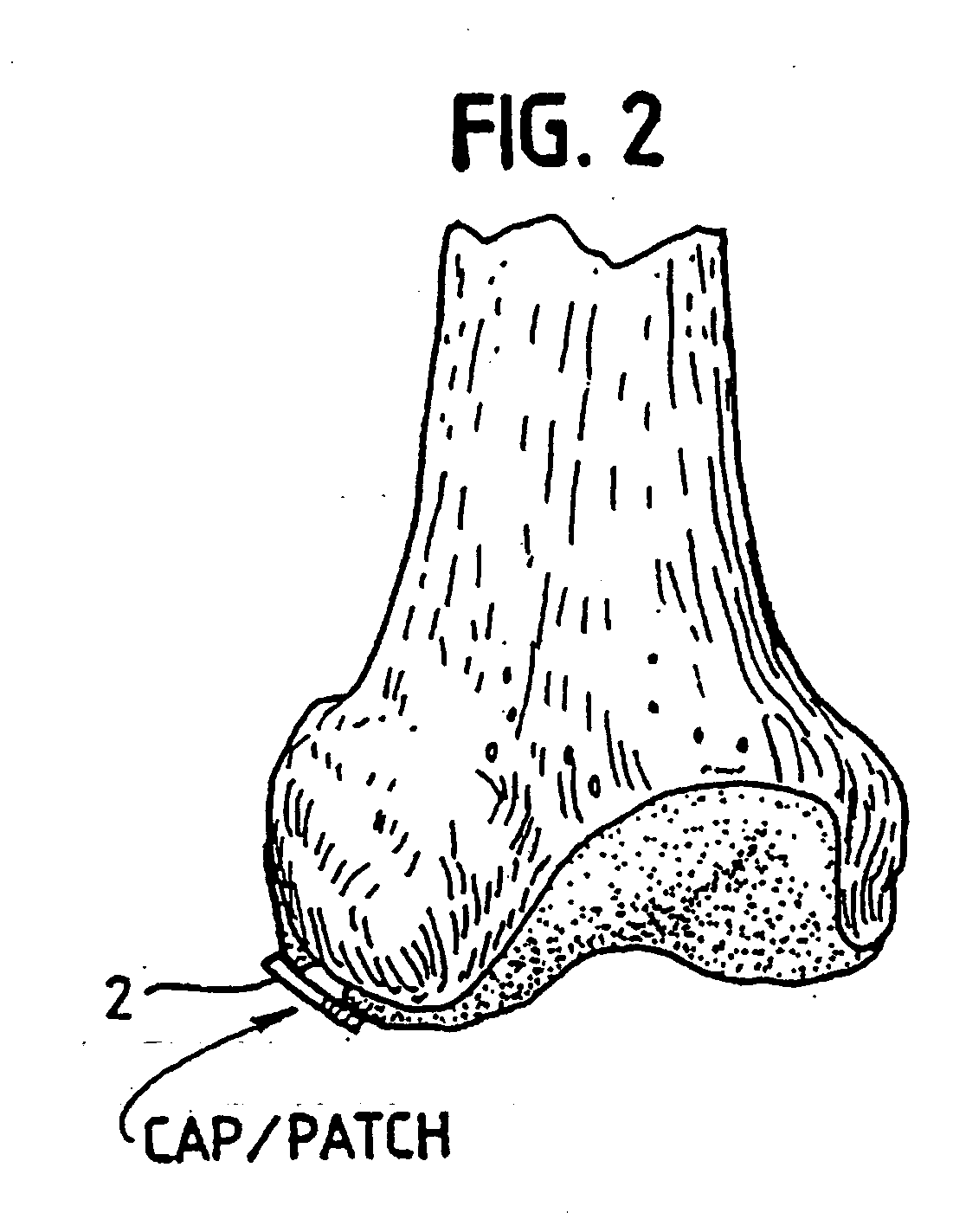 Method for autologous transplantation