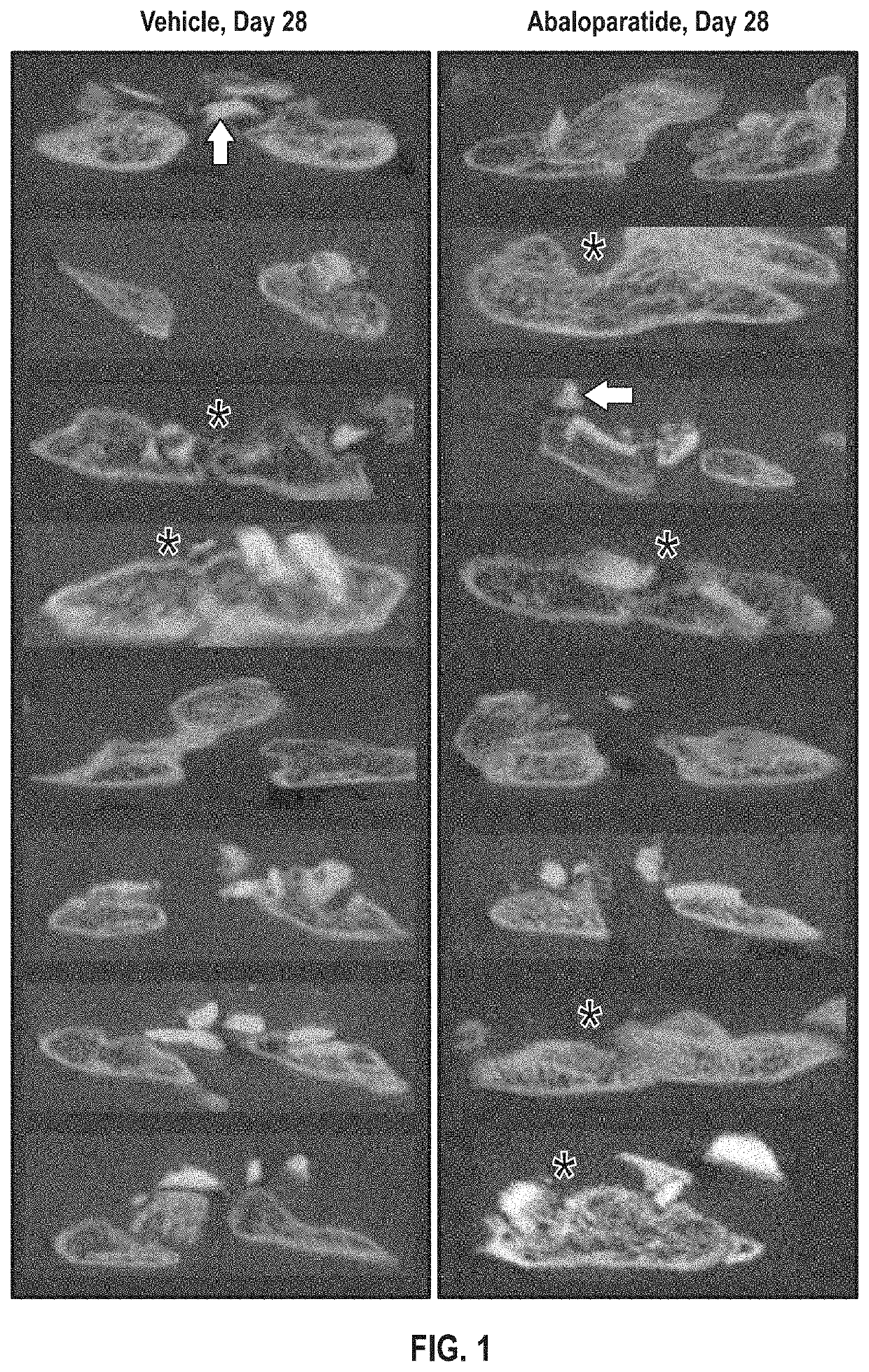 Methods of improving spinal fusion with abaloparatide