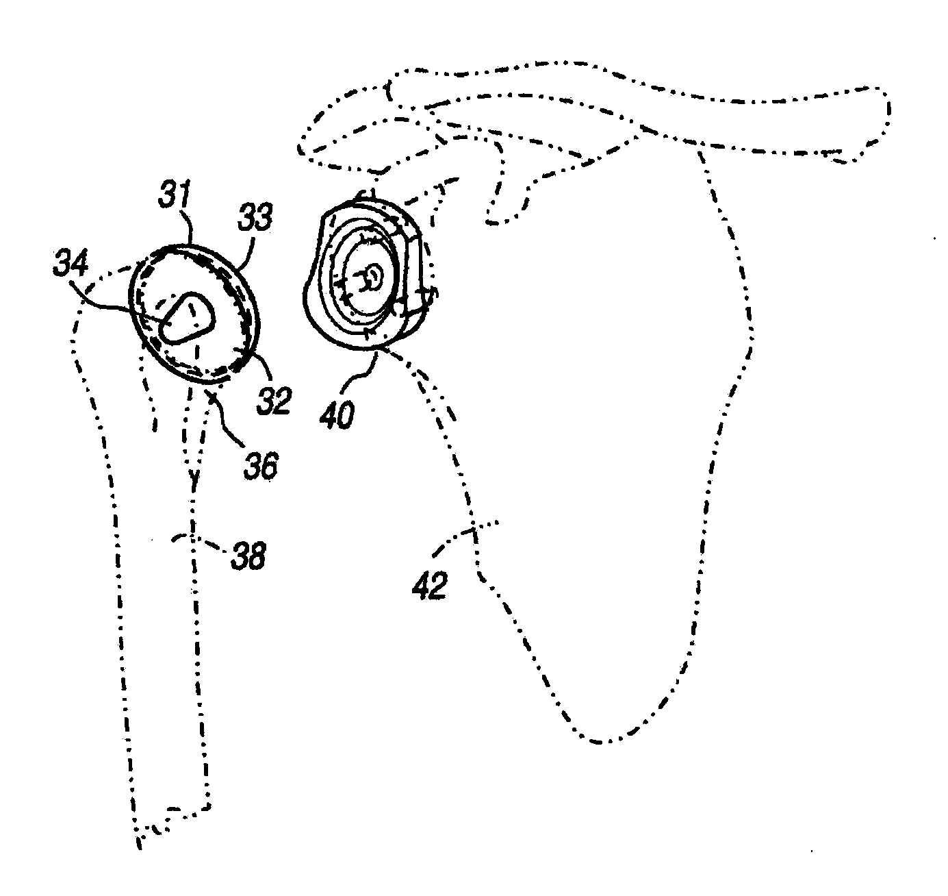 Modular Humeral Head Resurfacing System