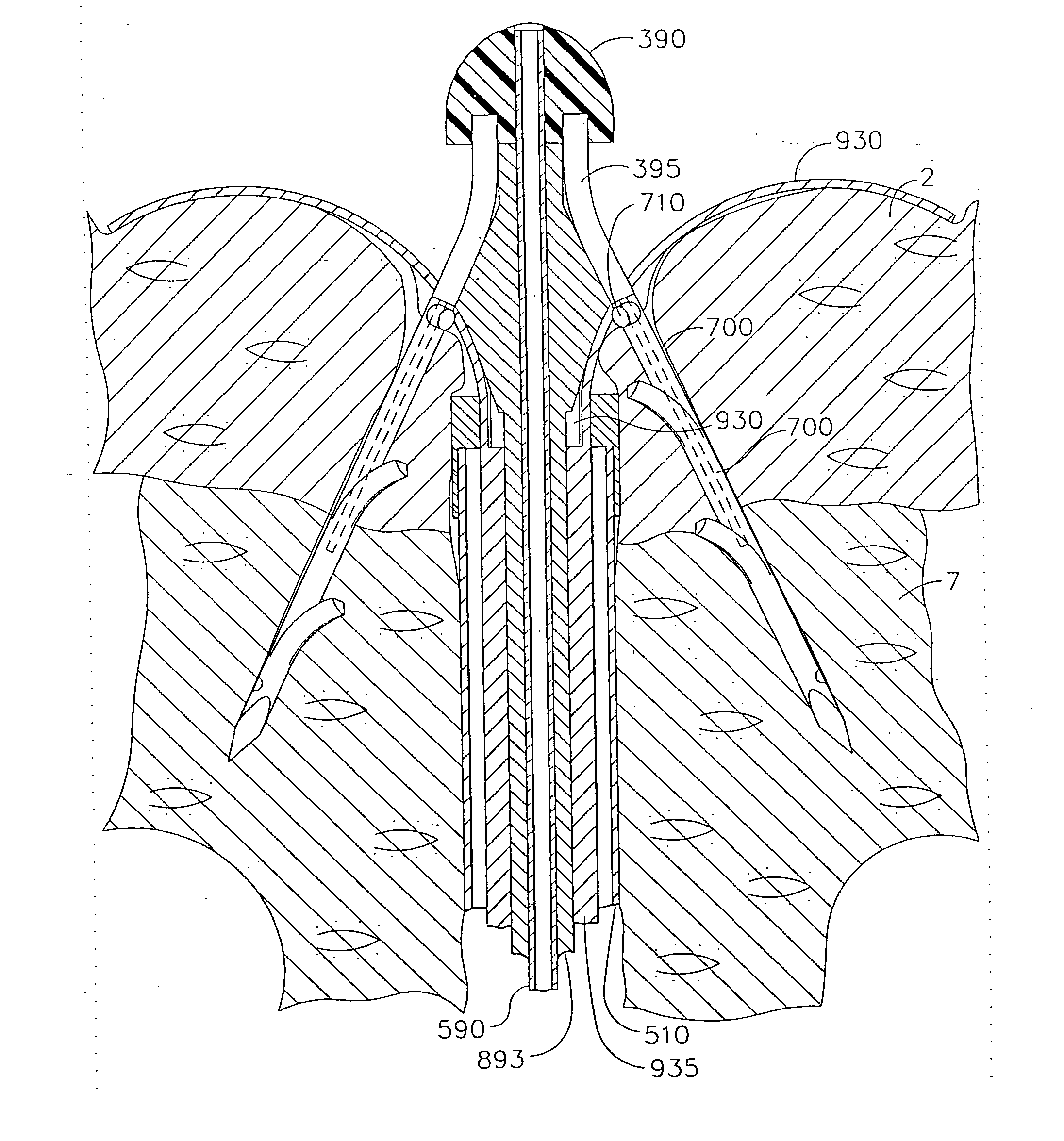 Anchors for use in attachment of bladder tissues to pelvic floor tissues following a prostatectomy