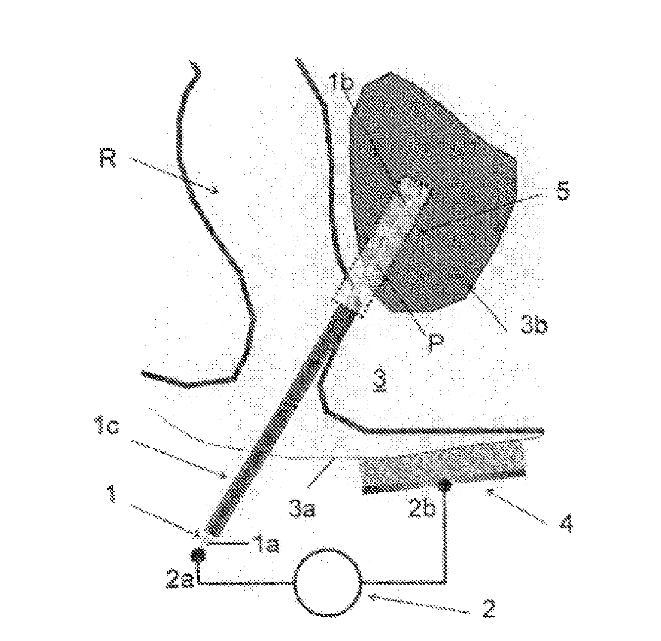 System for preventing bacterial infections in needle trajectories