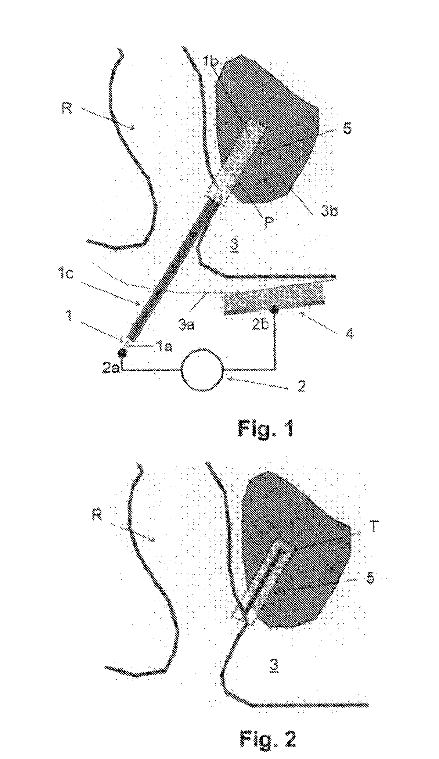 System for preventing bacterial infections in needle trajectories