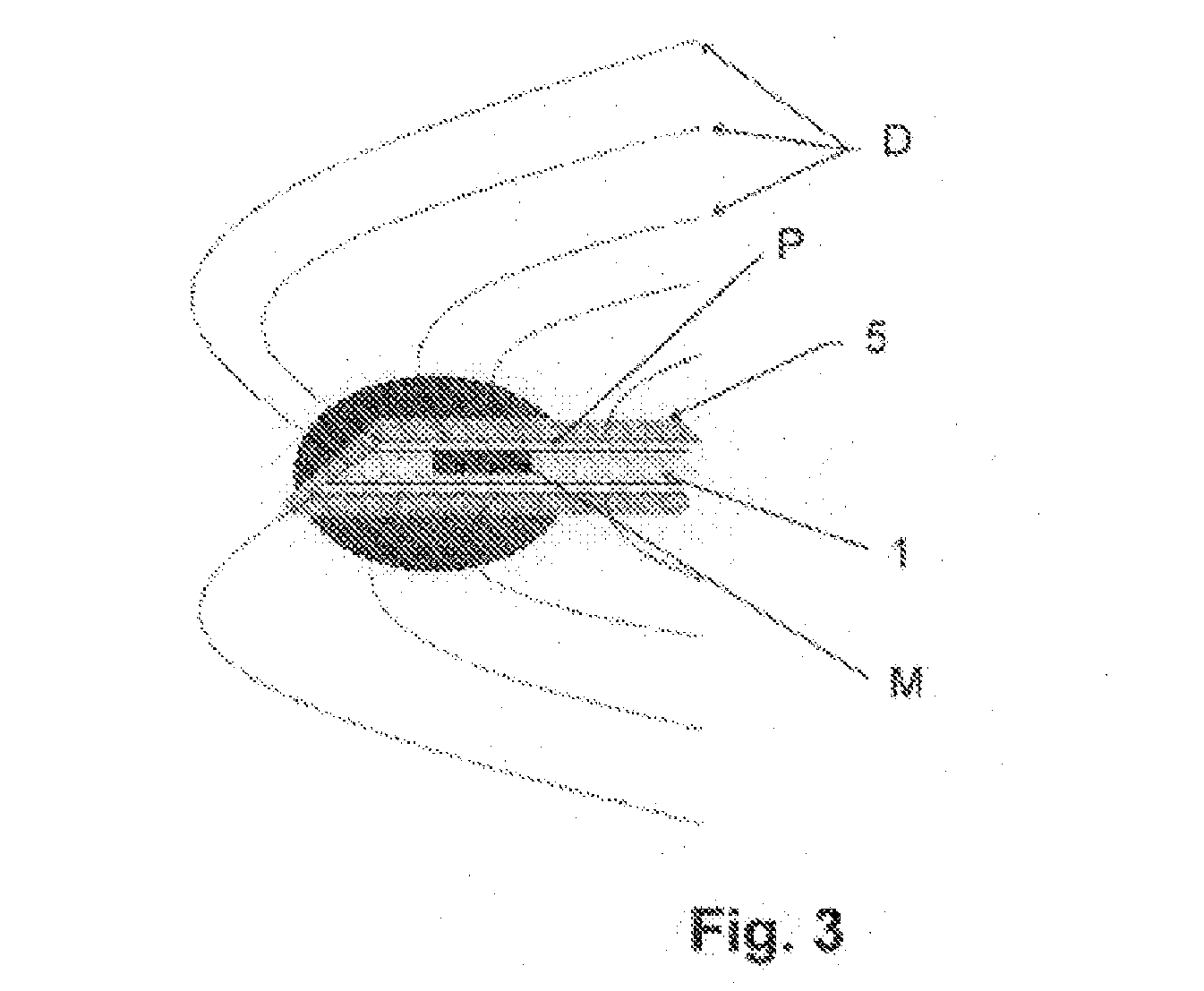 System for preventing bacterial infections in needle trajectories