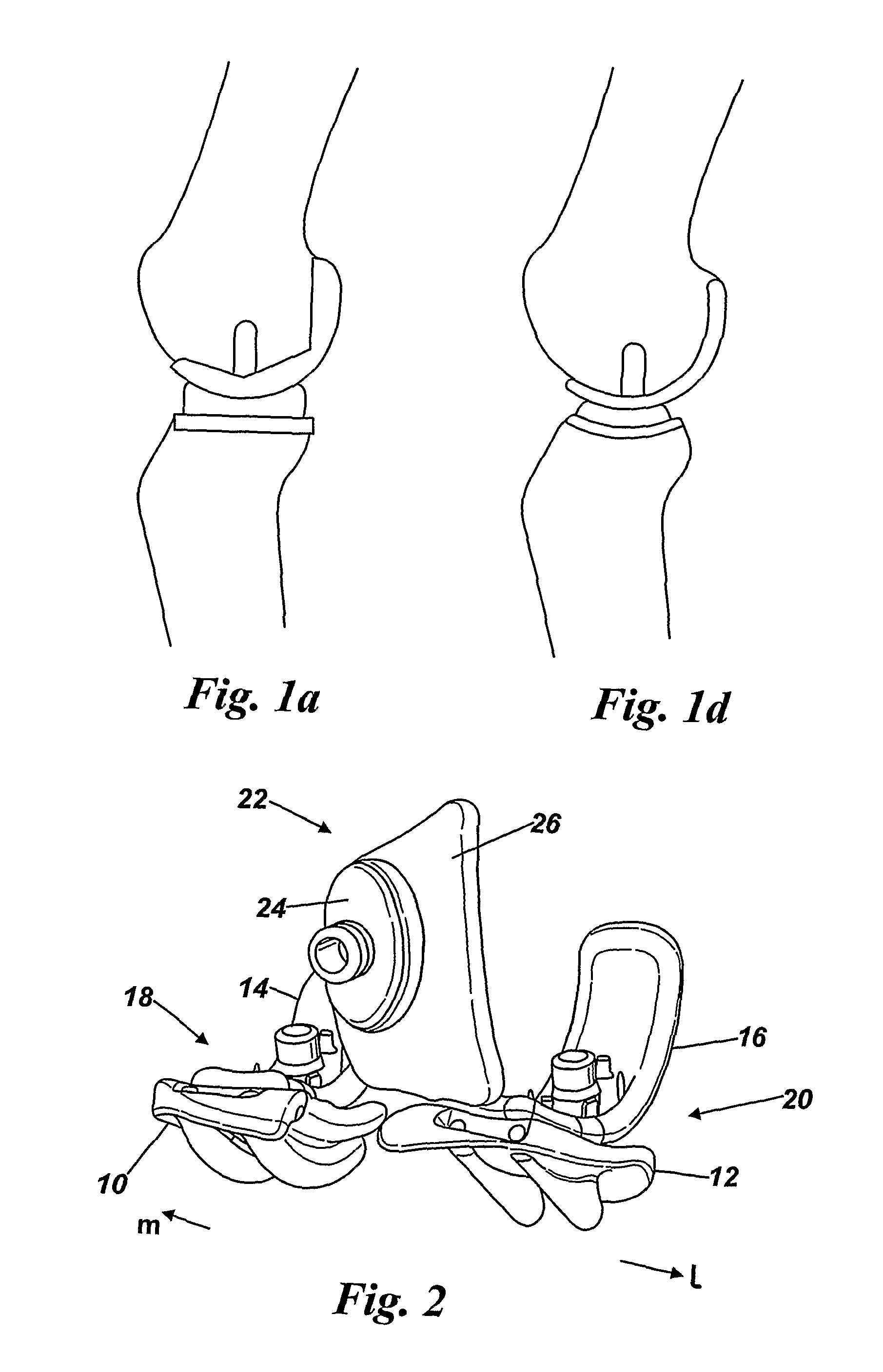 Modular knee implants