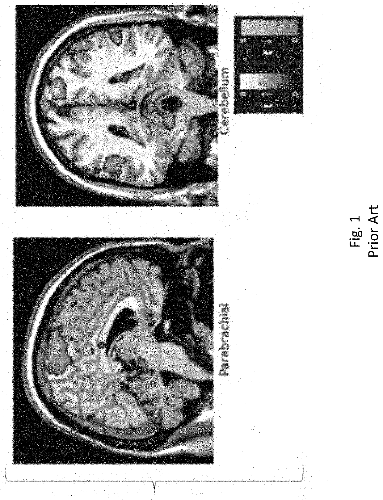 Non-invasive proprioceptive stimulation for treating epilepsy