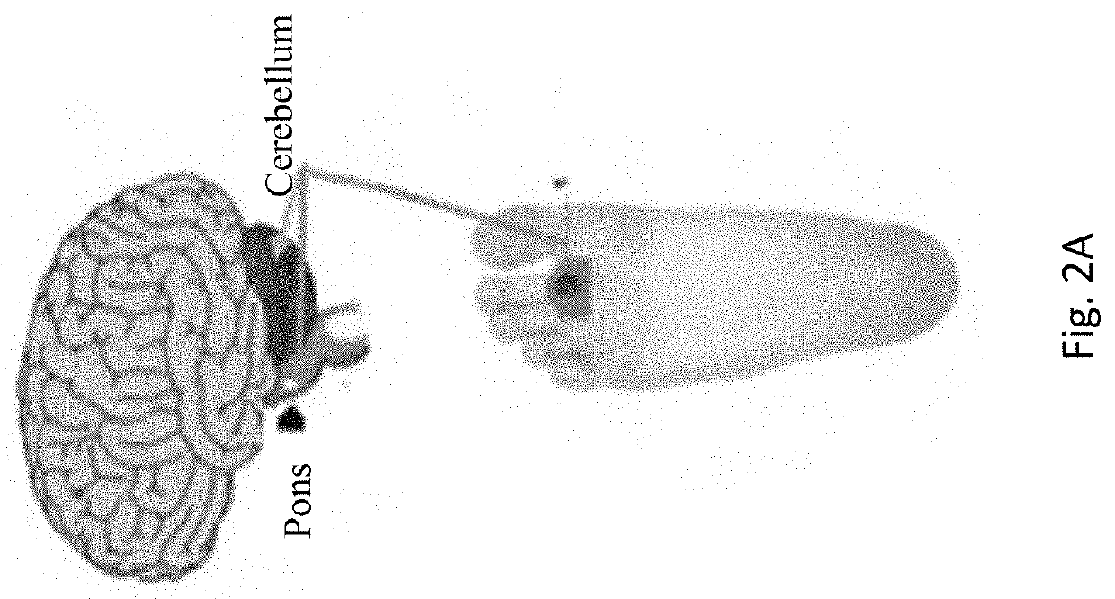 Non-invasive proprioceptive stimulation for treating epilepsy