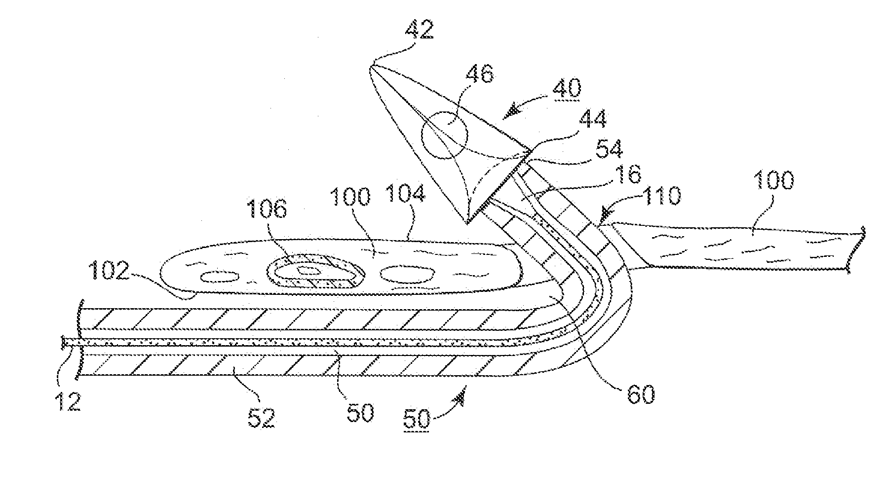 Minimally Invasive Methods and Apparatus for Accessing and Ligating Uterine Arteries with Sutures