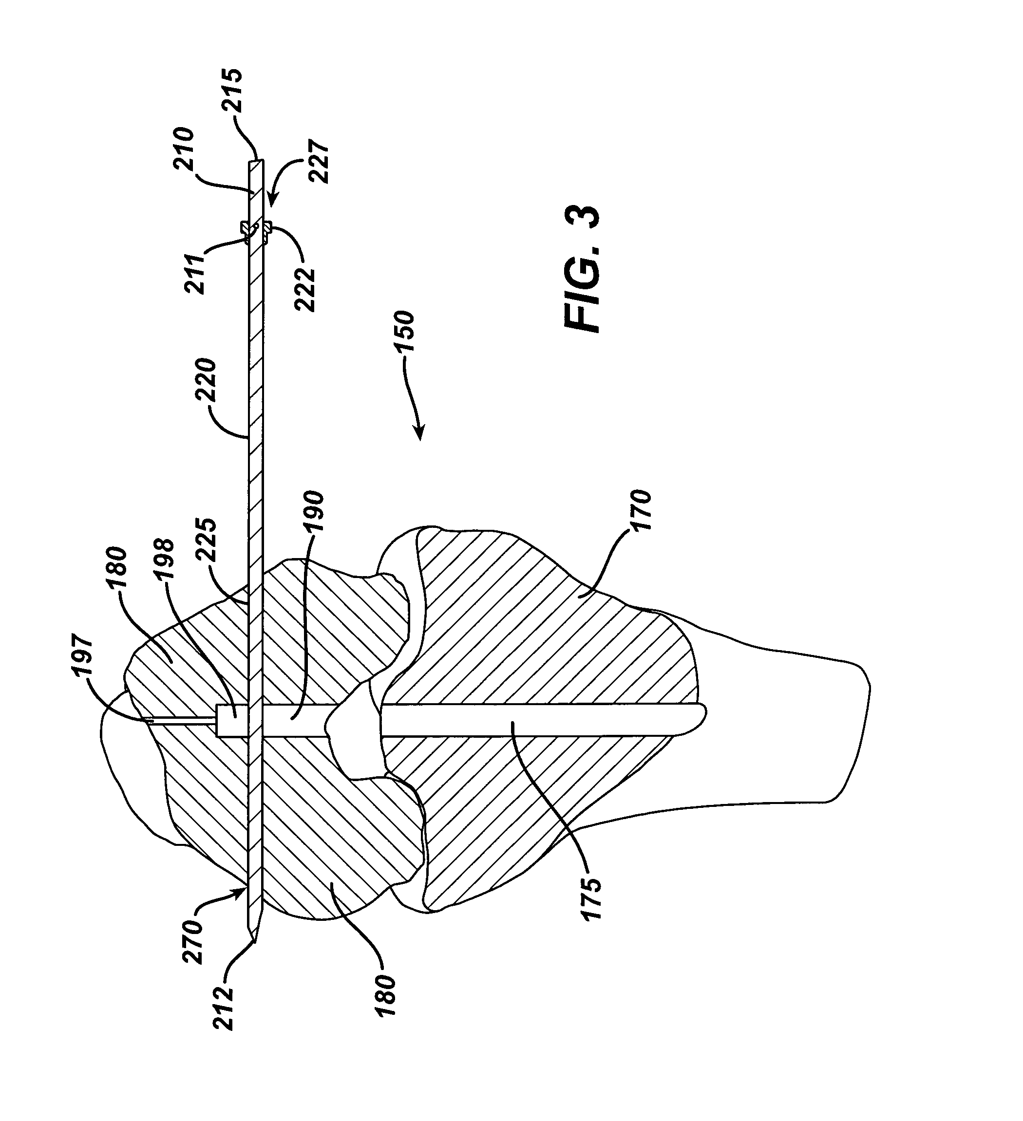 Implantable cross-pin for anterior cruciate ligament repair