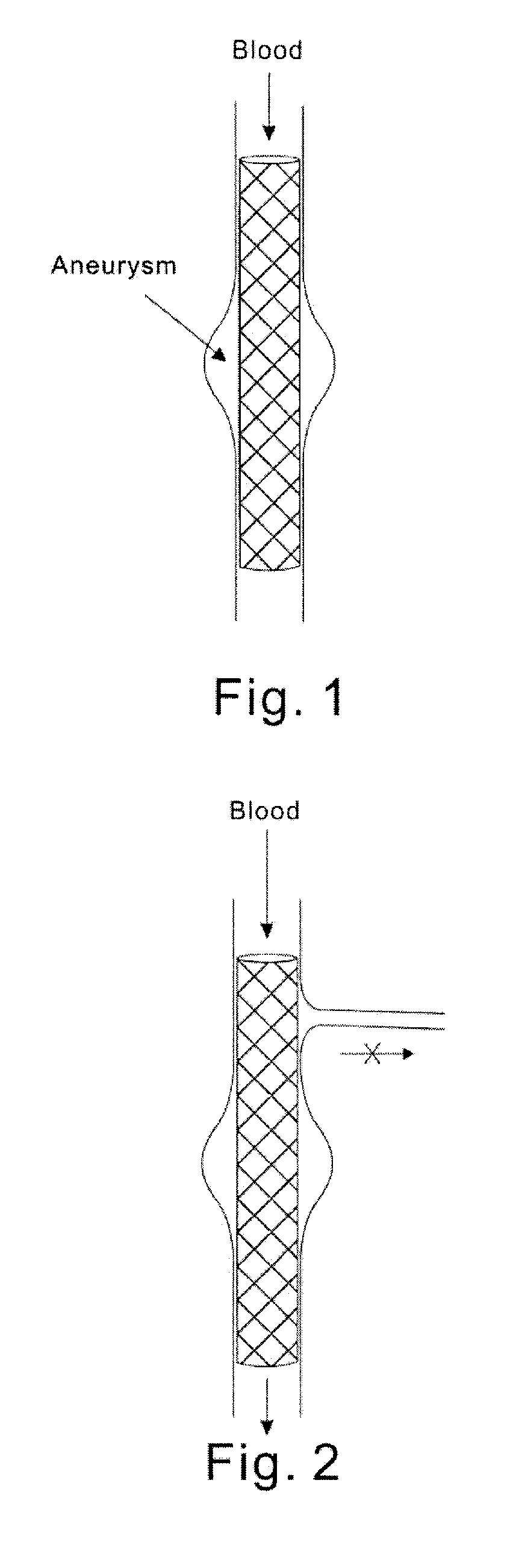 Modular stent graft and delivery system