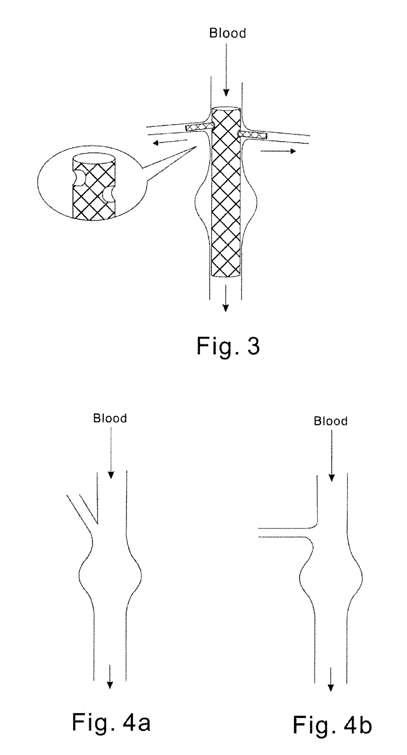 Modular stent graft and delivery system