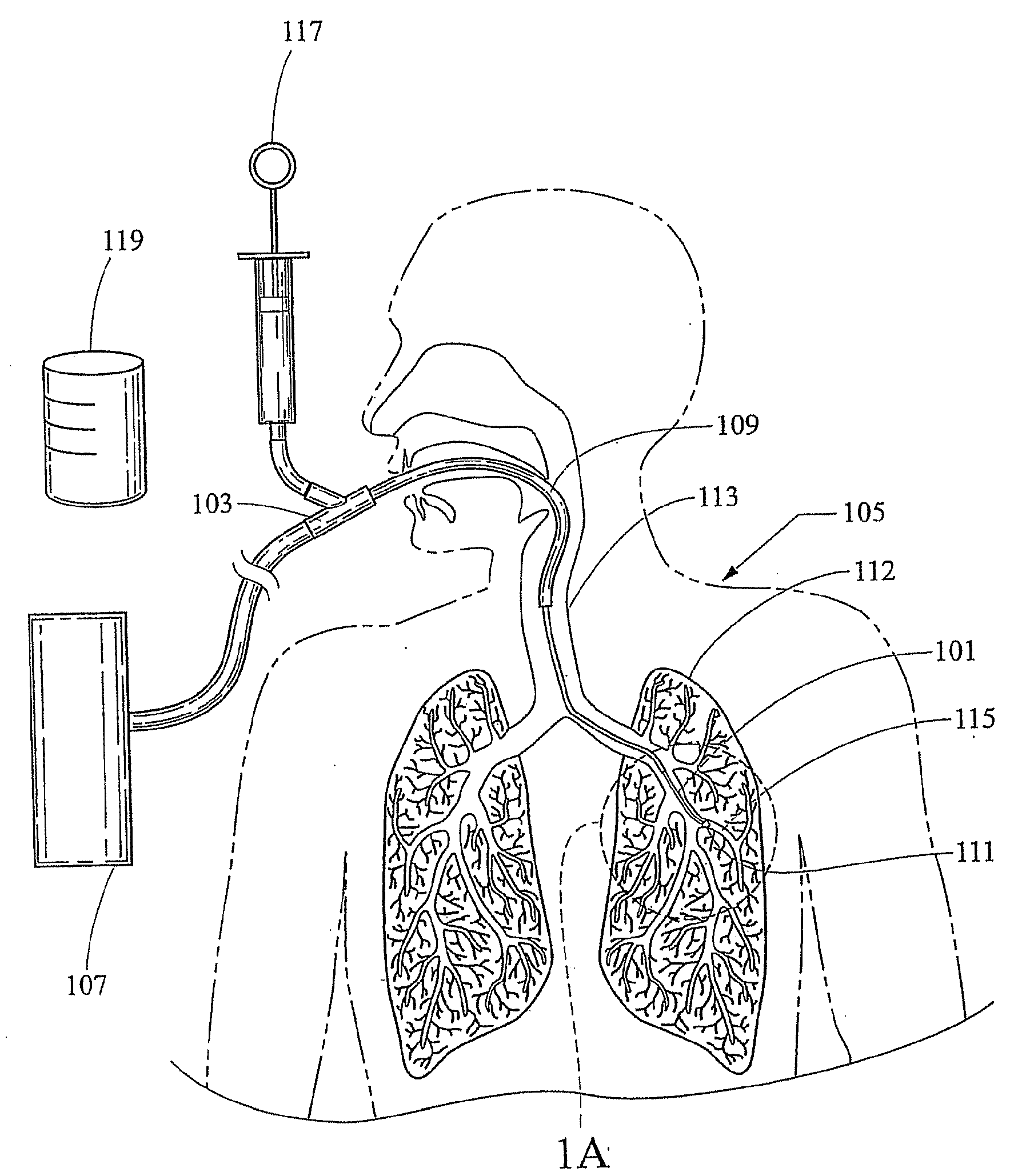 Bronchoalveolar lavage catheter assembly