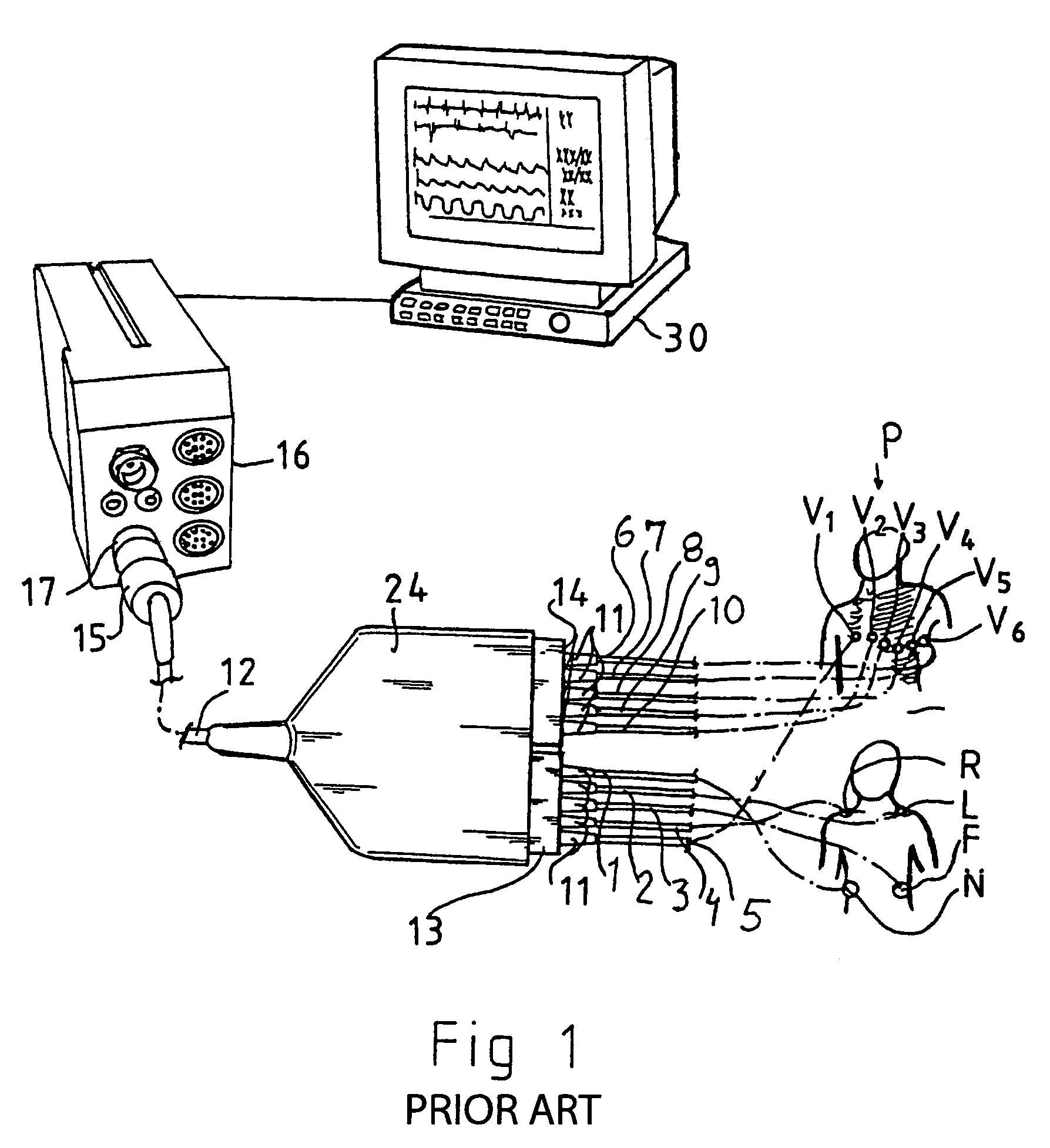 Shield arrangement for ECG lead wires