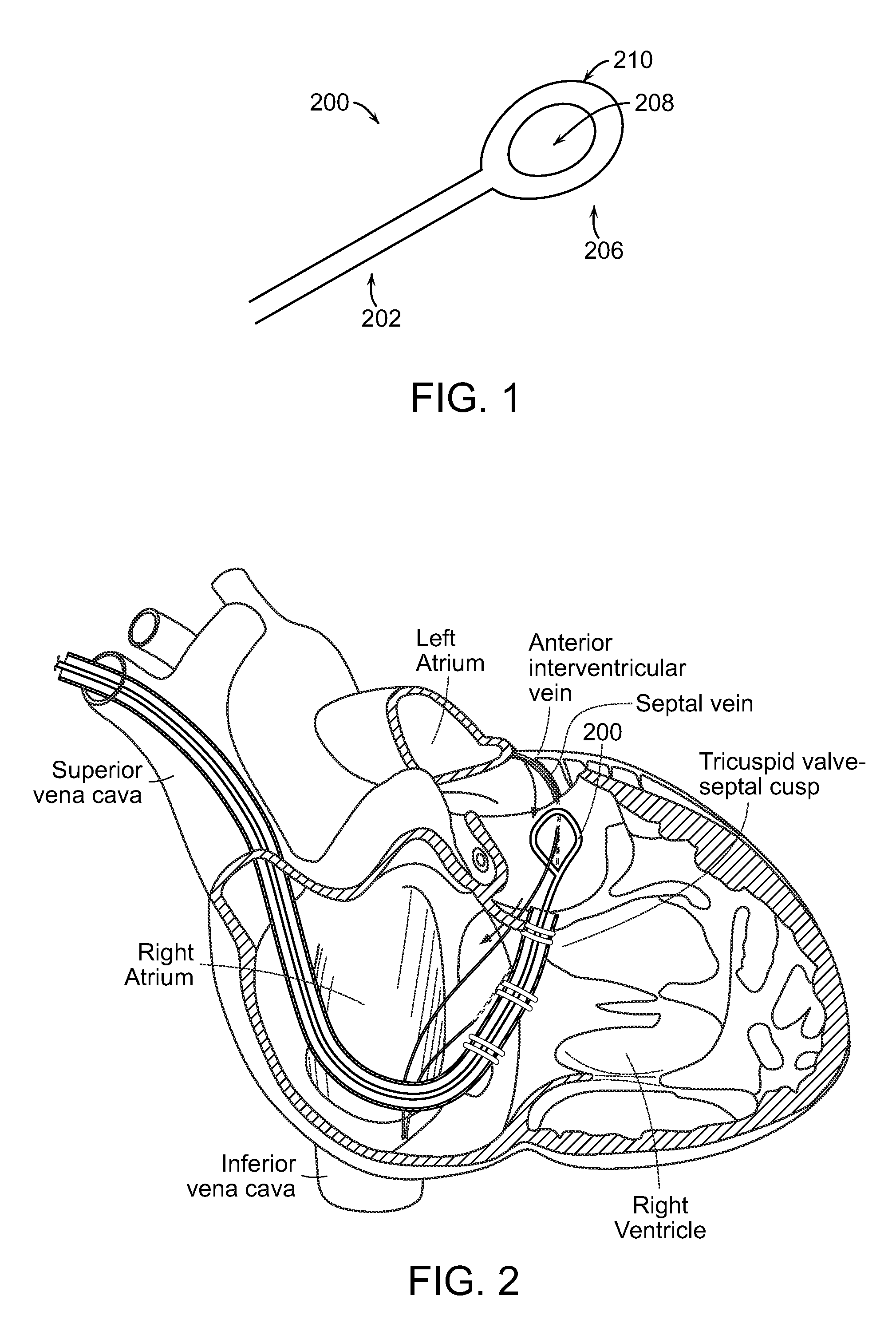 Methods and devices for transcatheter cerclage annuloplasty