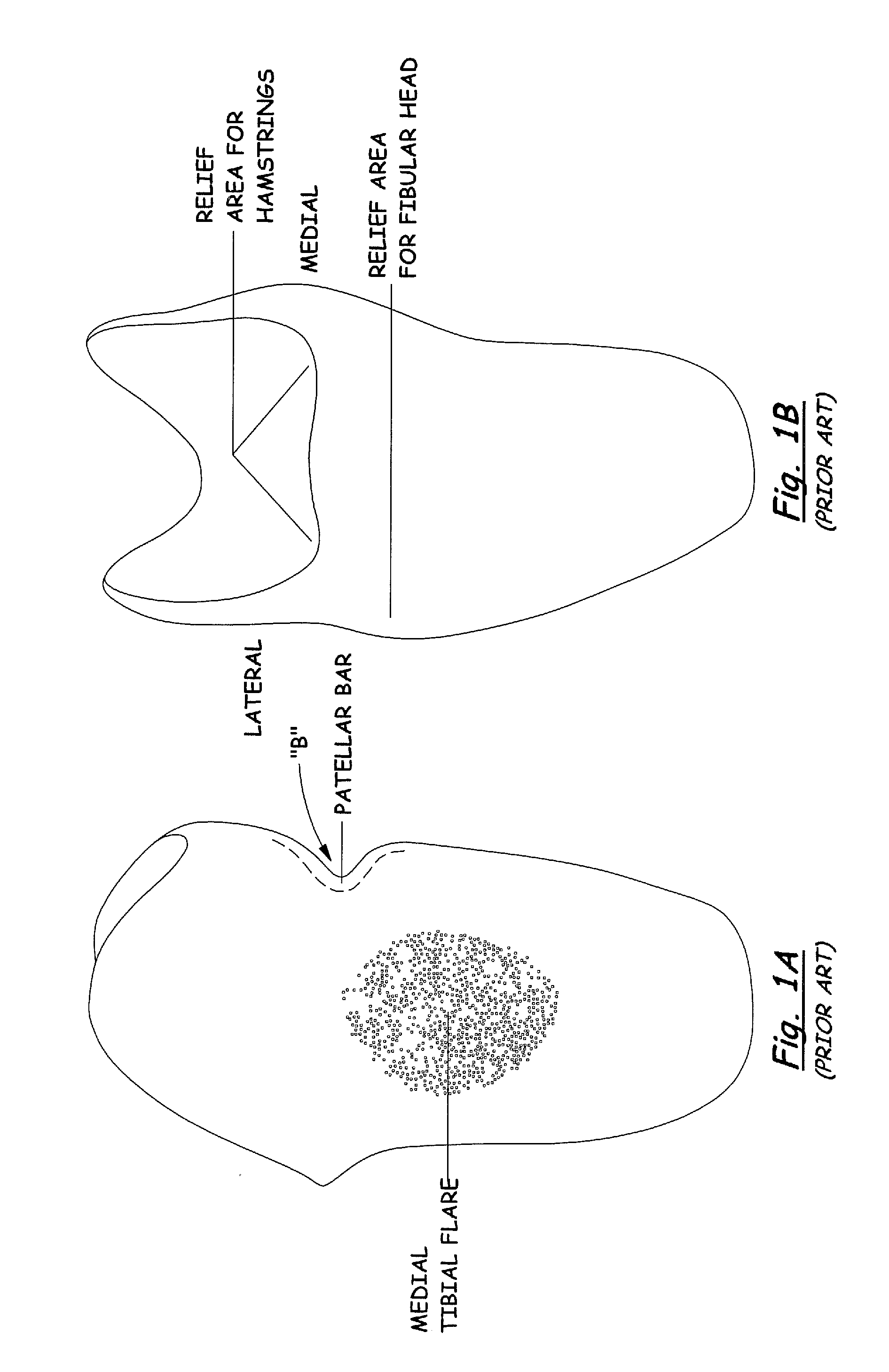 Transtibial socket for external prosthesis