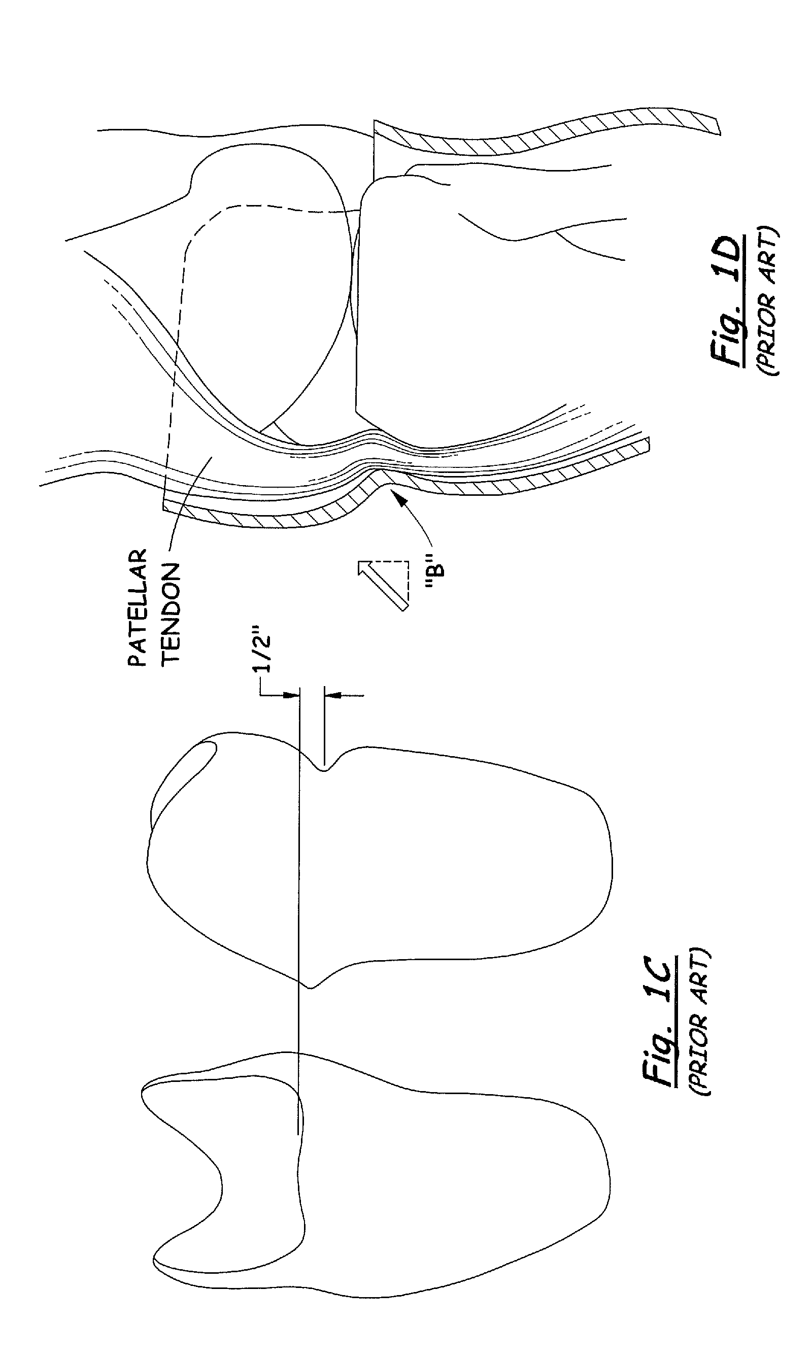 Transtibial socket for external prosthesis