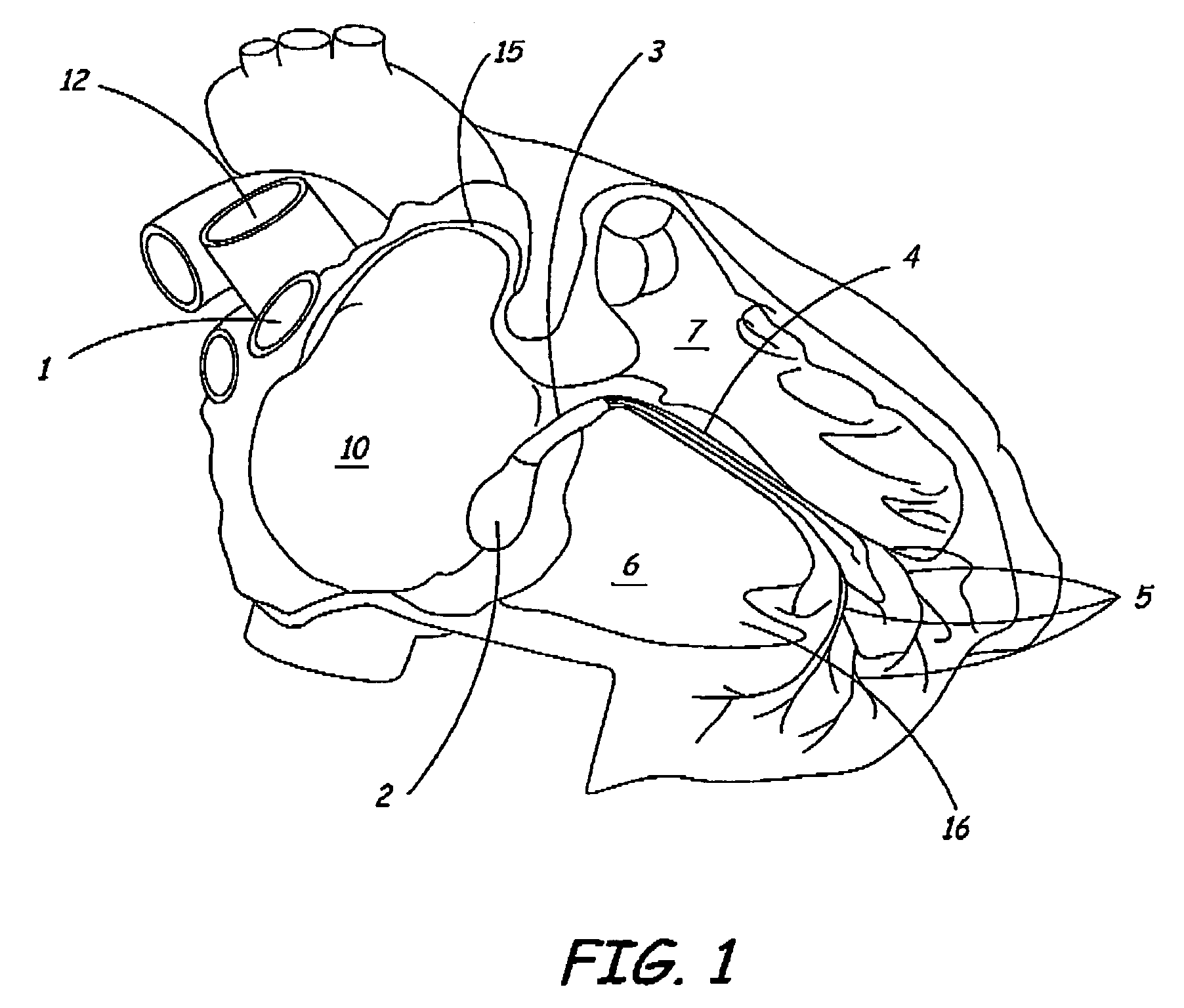 Multipolar pacing method and apparatus