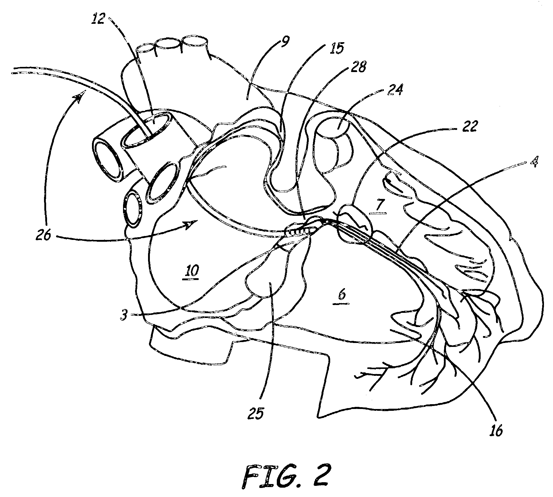 Multipolar pacing method and apparatus