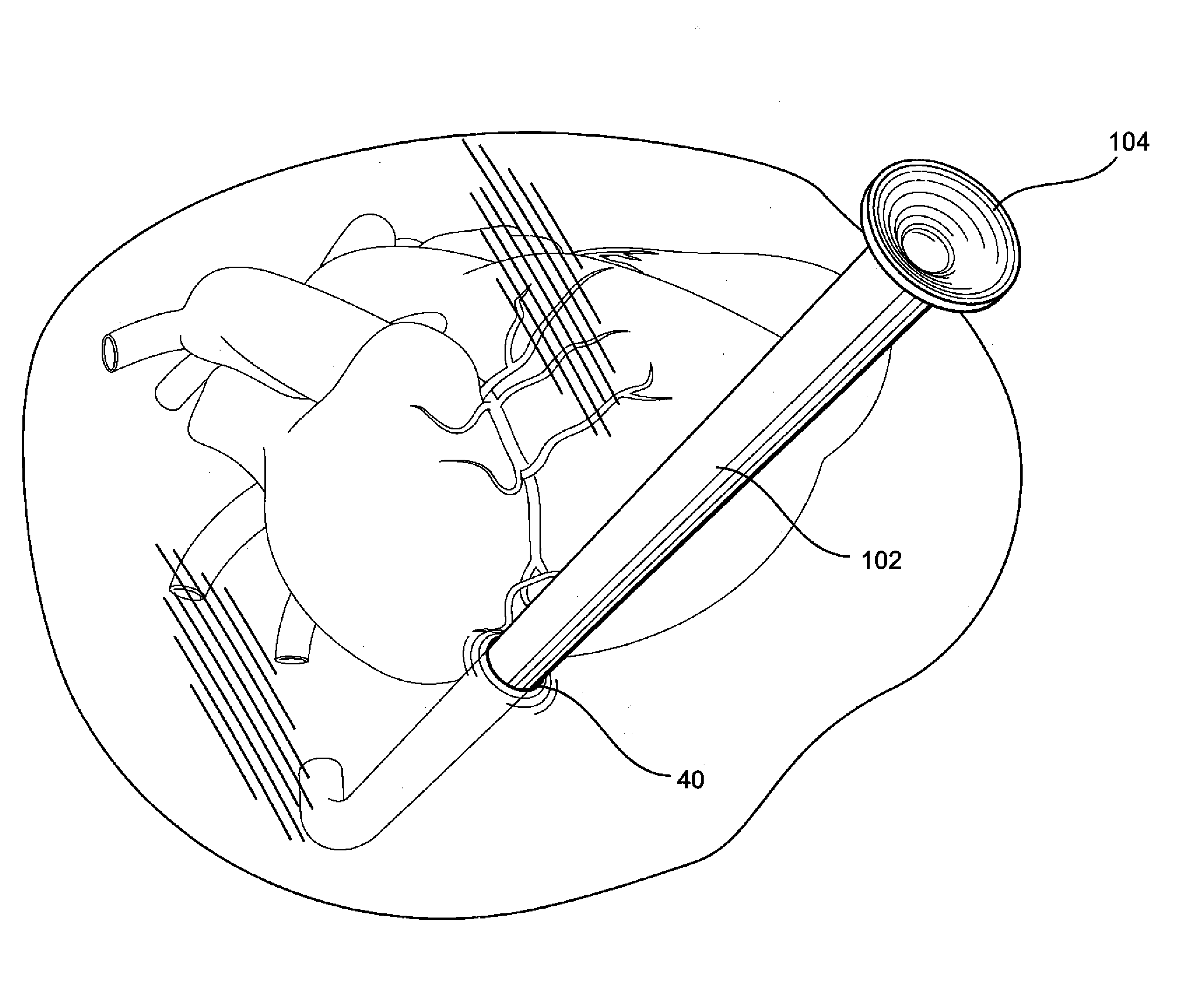 Introductory assembly and method for inserting intracardiac instruments