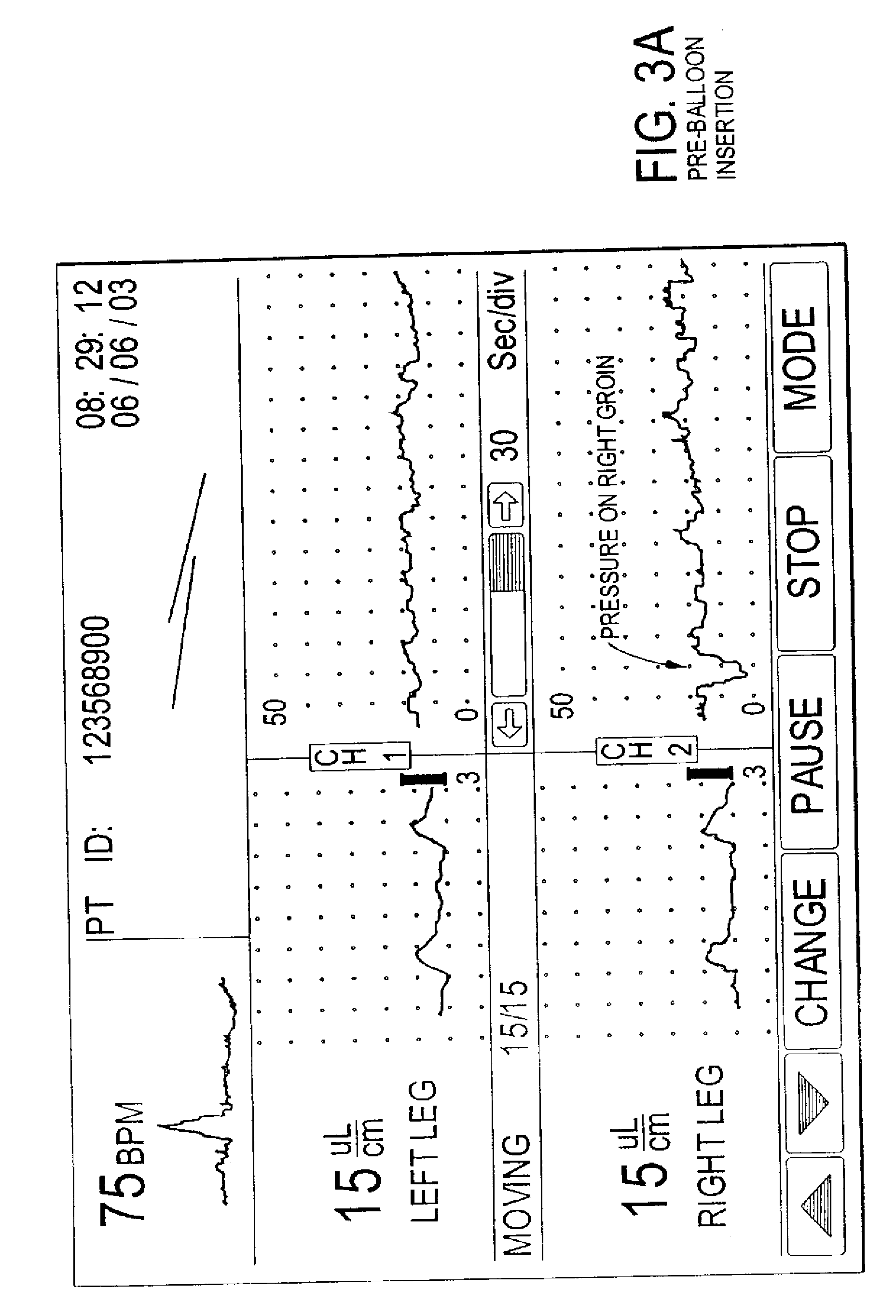 Methods of diagnosis using pulse volume measurement