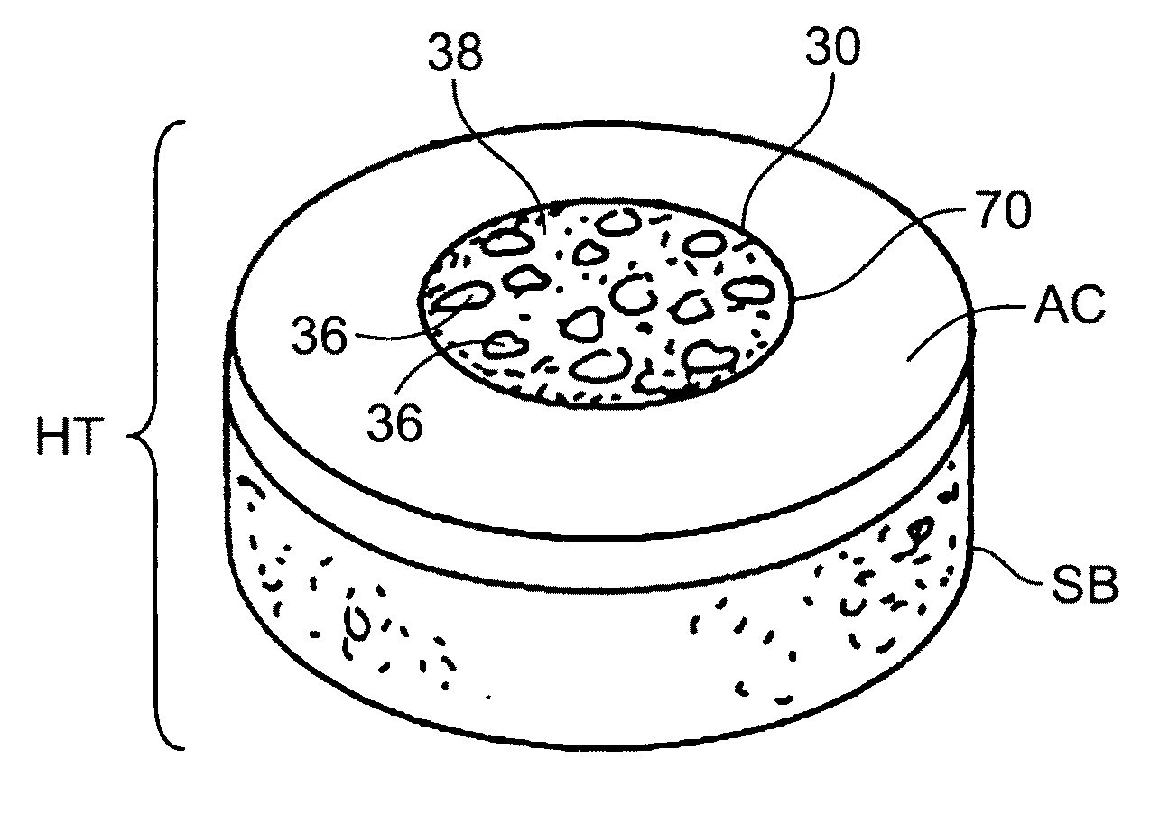 Allograft osteochondral plug combined with cartilage particle mixture