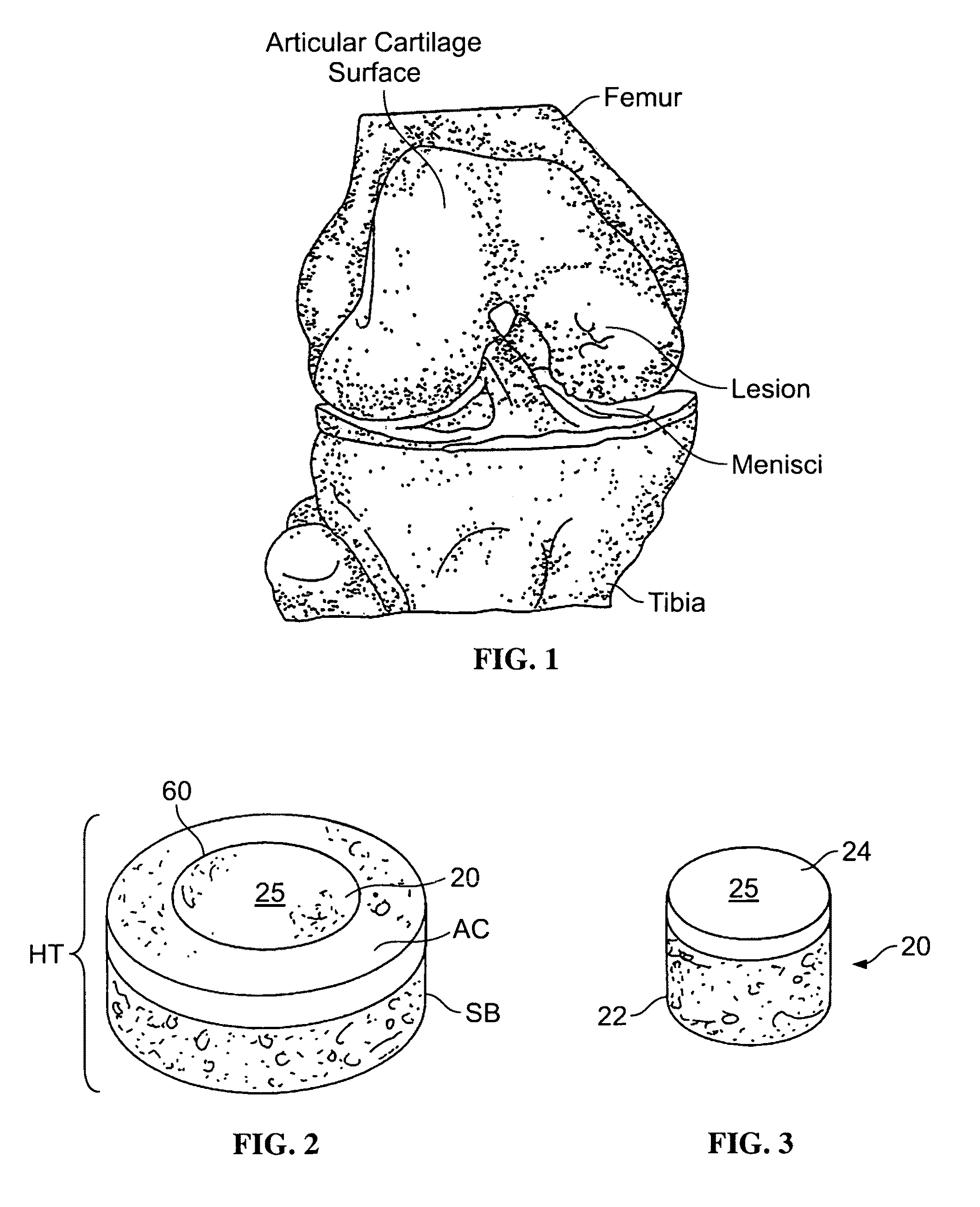 Allograft osteochondral plug combined with cartilage particle mixture