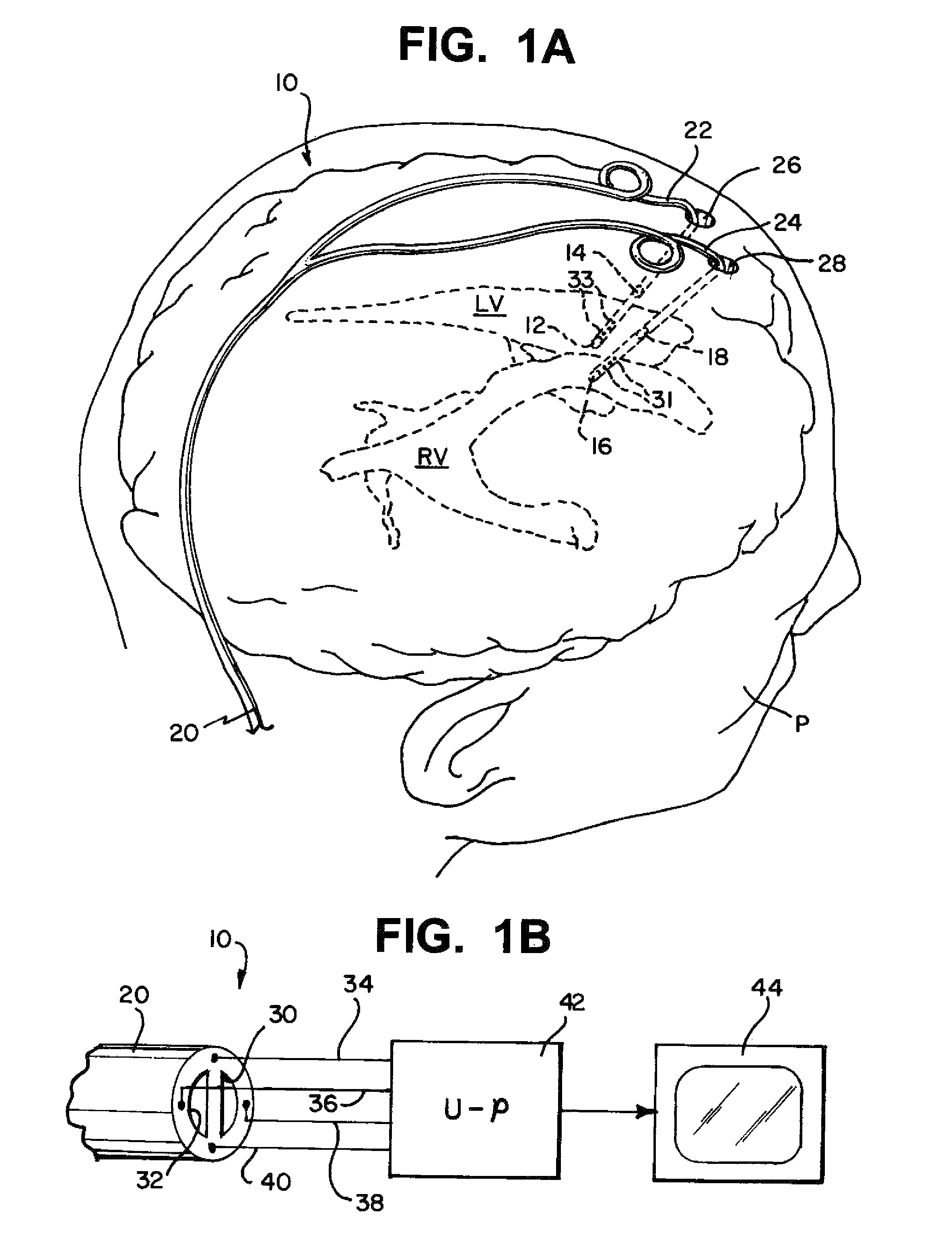 Cerebral compliance monitoring