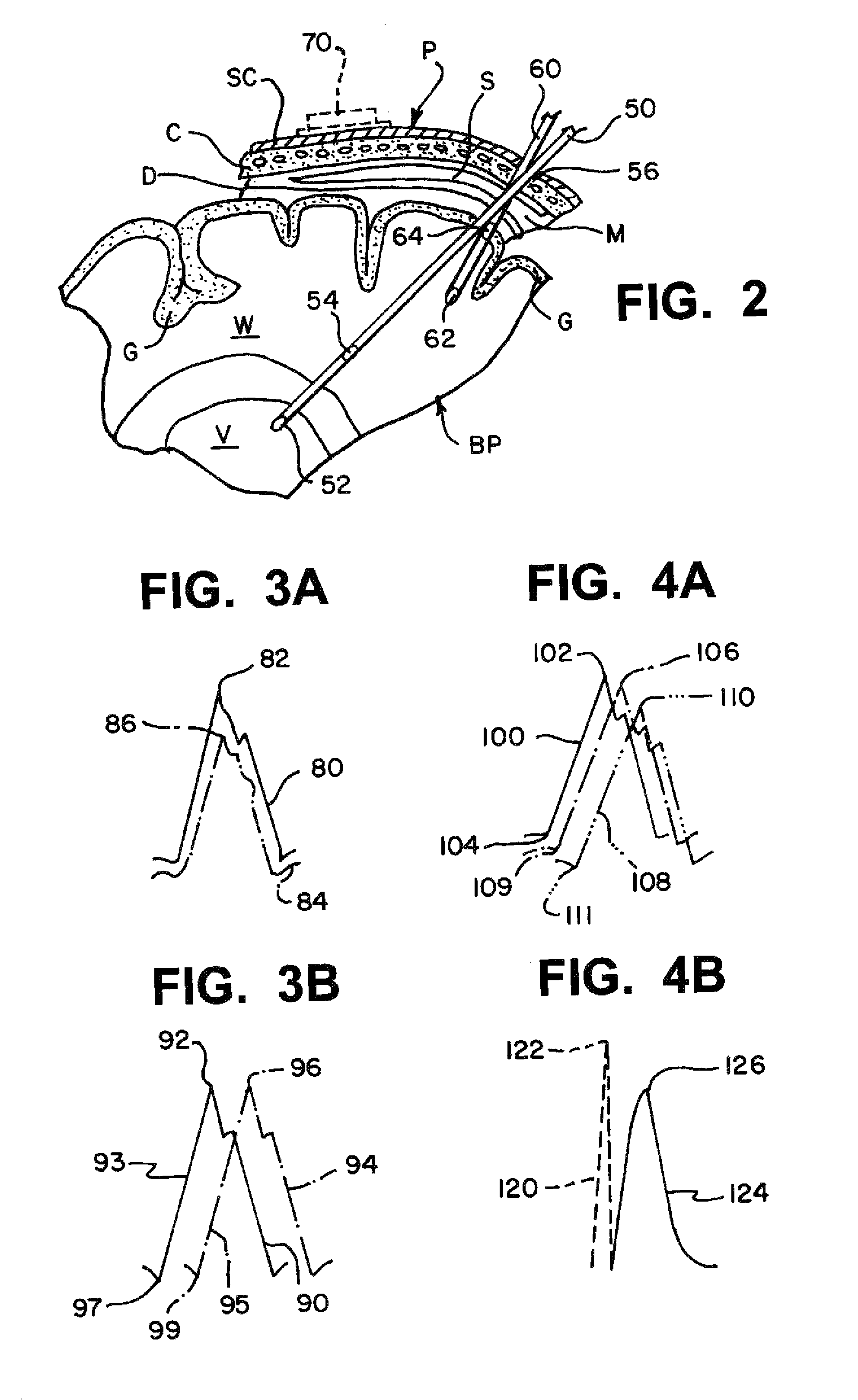 Cerebral compliance monitoring