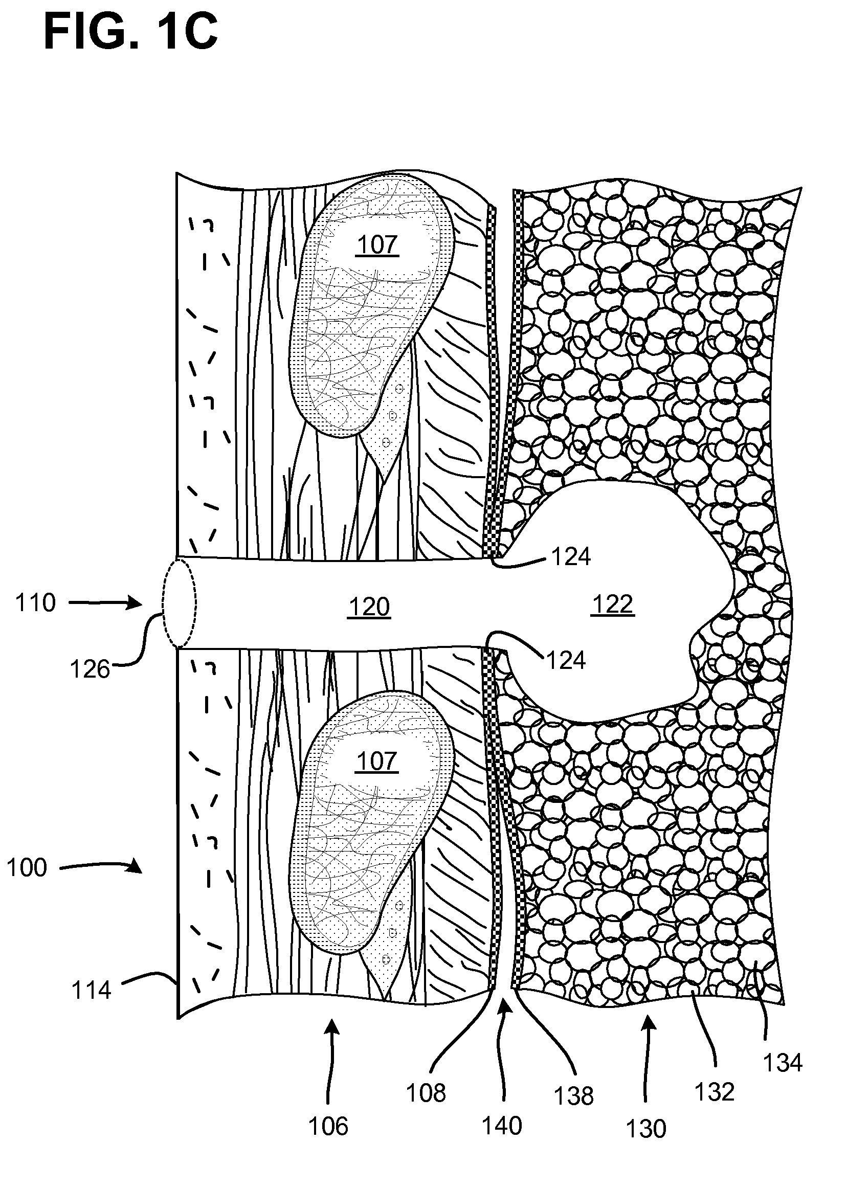 Pneumostoma management system for treatment of chronic obstructive pulmonary disease