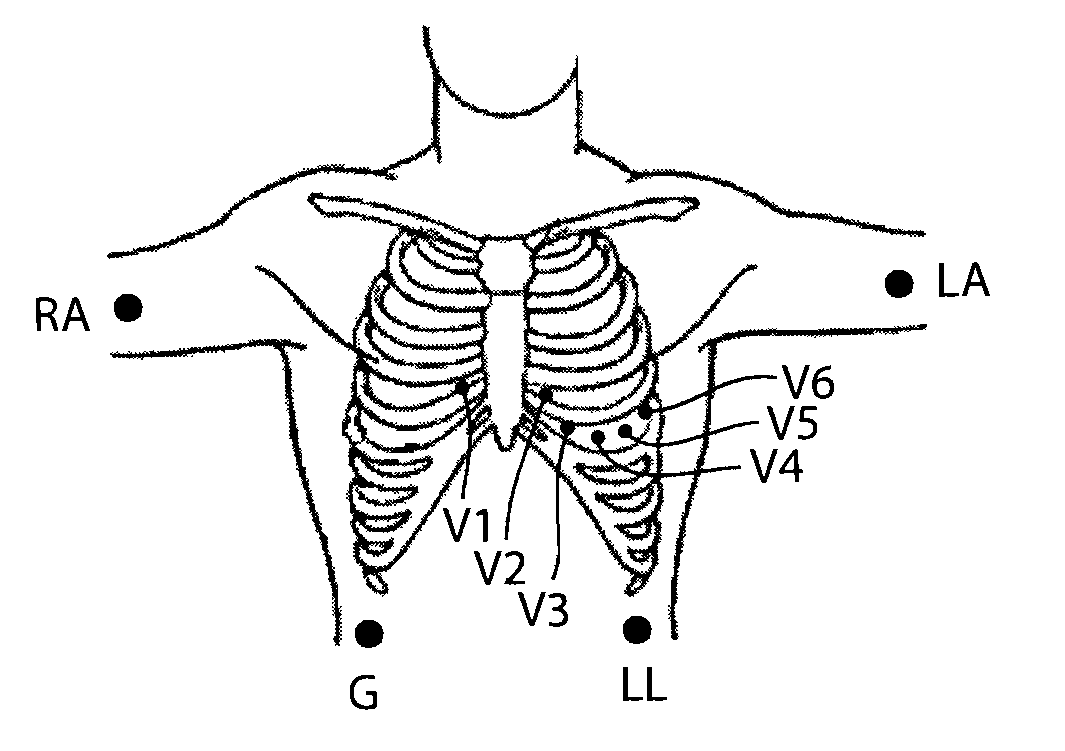 Method and apparatus with reduced electrode system specific ECG interpretation