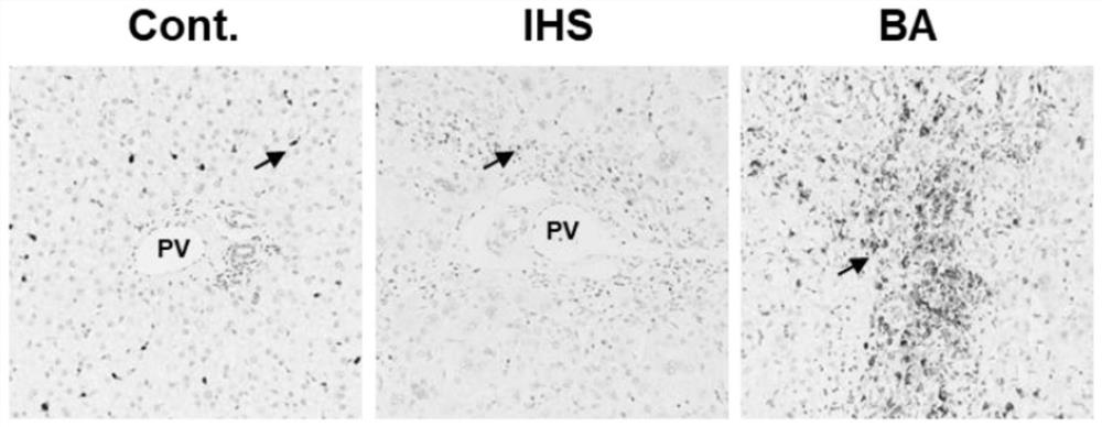 Application of neutrophil elastase in the preparation of products for diagnosing biliary atresia