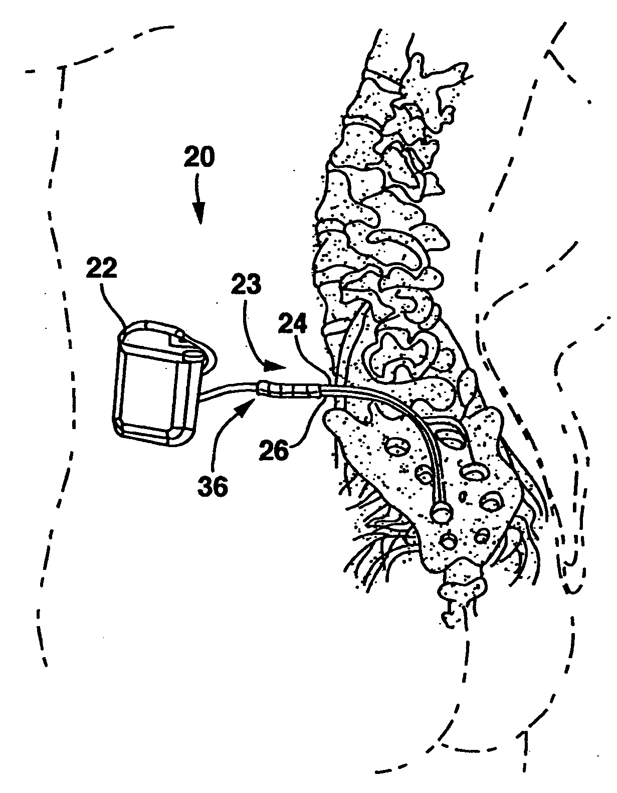 Method of use of implantable percutaneous stimulation lead