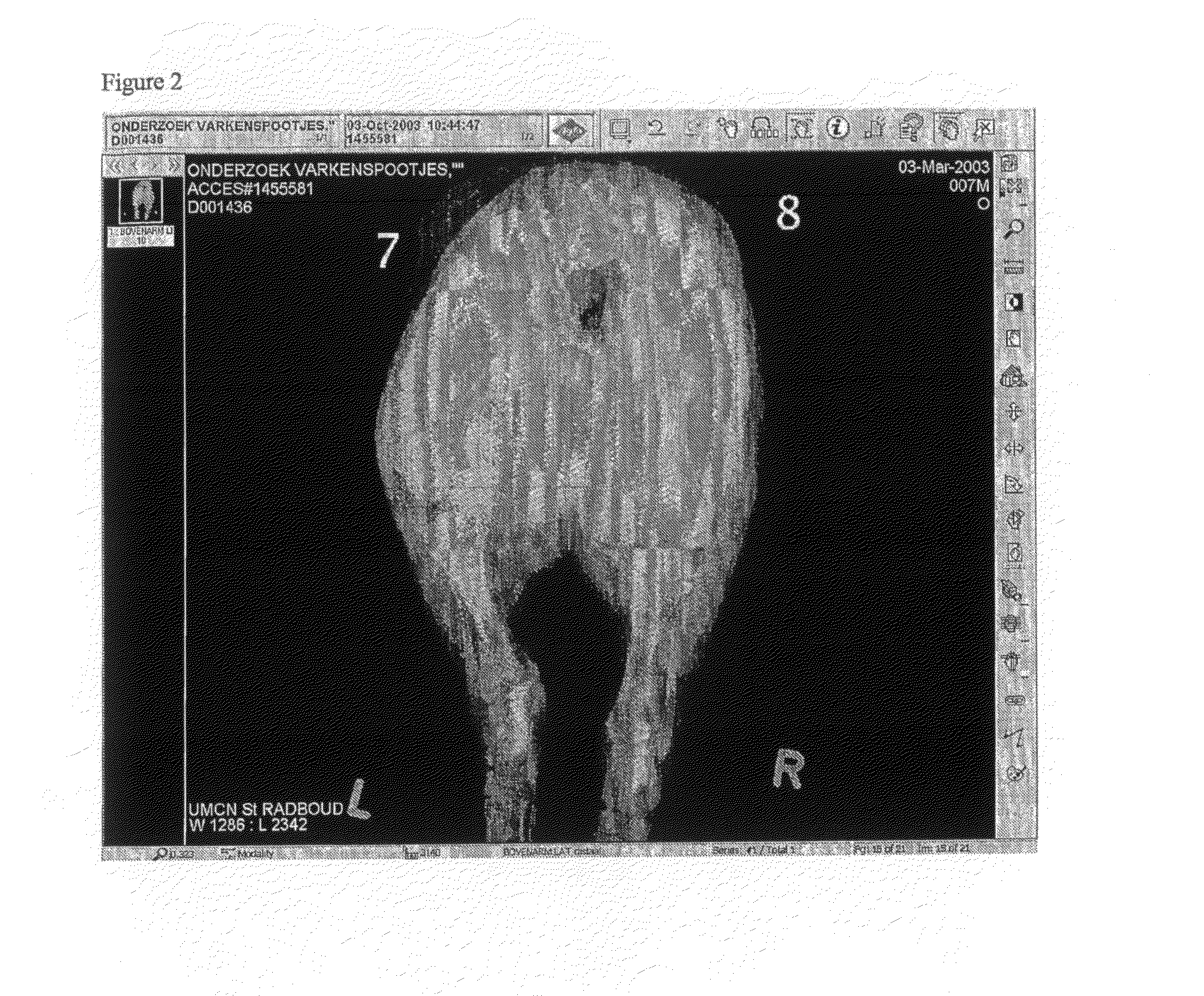 X-Ray Visible Drug Delivery Device