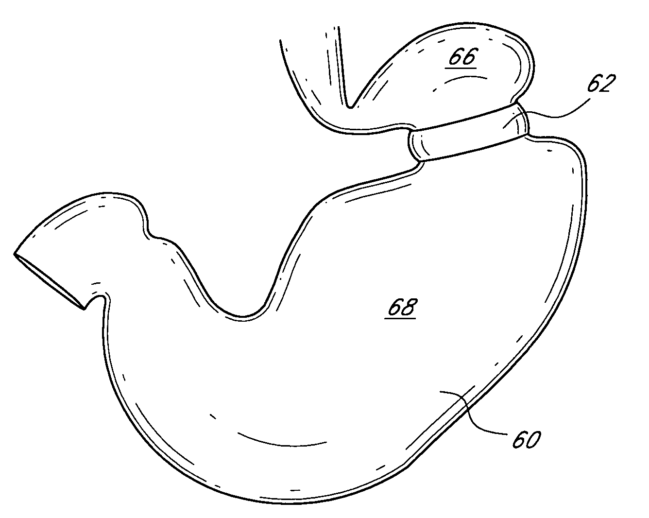 Dynamically adjustable gastric implants and methods of treating obesity using dynamically adjustable gastric implants
