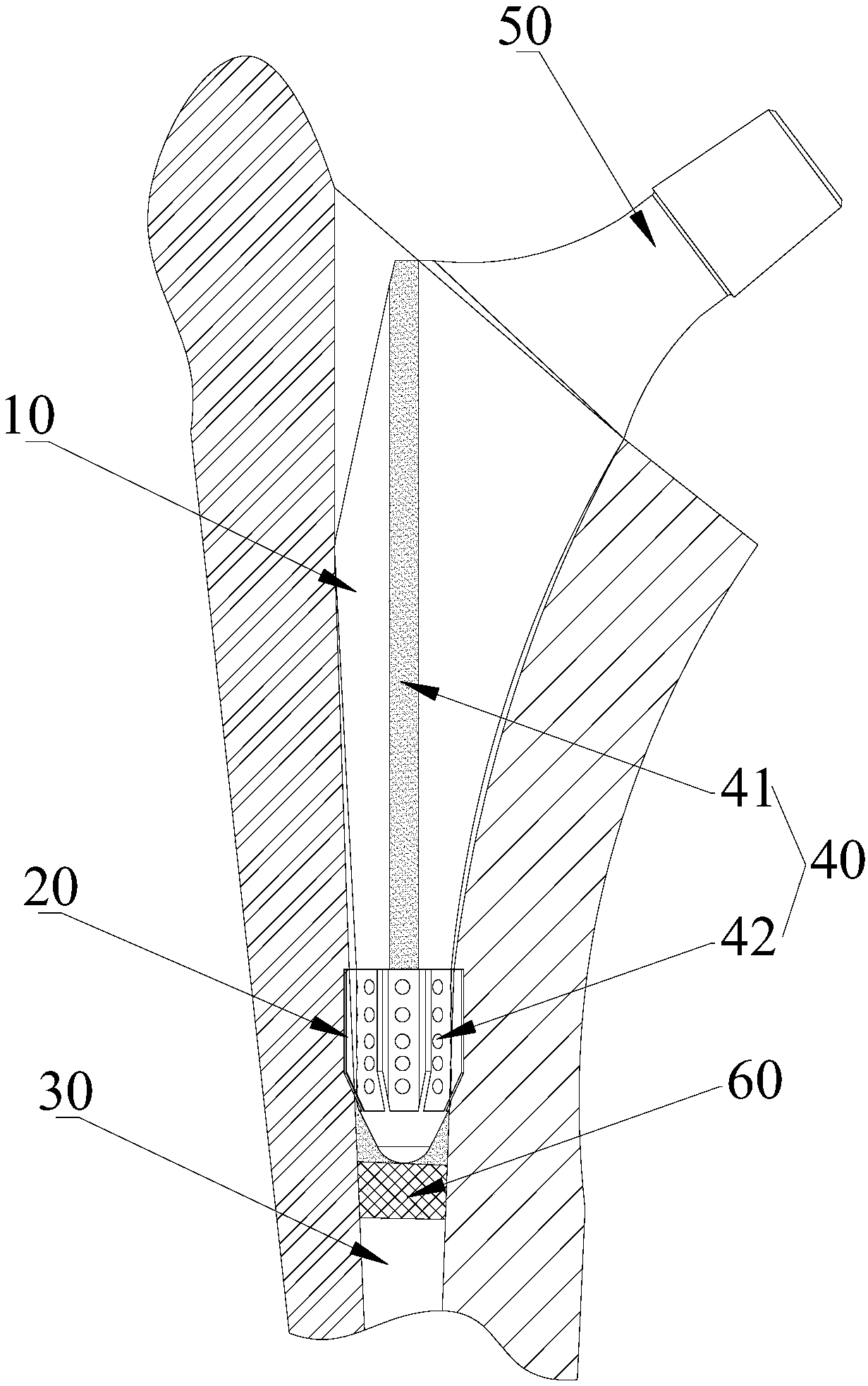 Femoral stem prosthesis