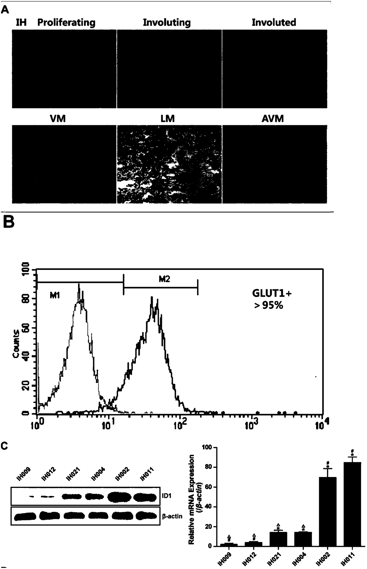 Product used for evaluating effect of propranolol in treatment of infant hemangioma