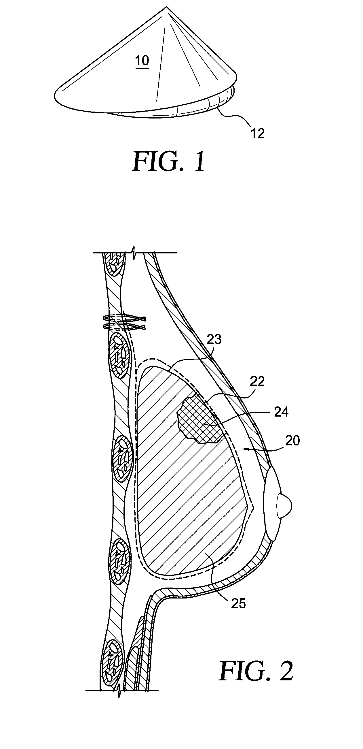 Self supporting and forming breast implant and method for forming and supporting an implant in a human body